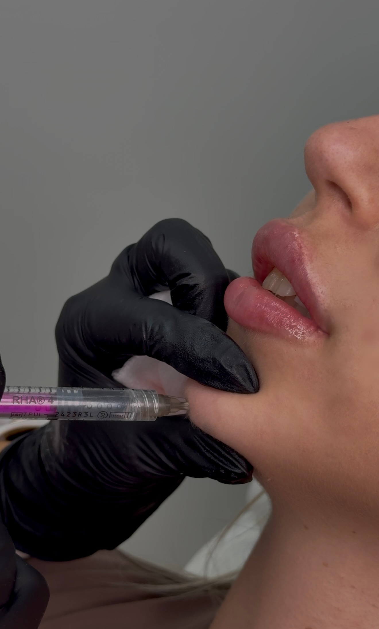 Dermal Filler | Dermal Filler