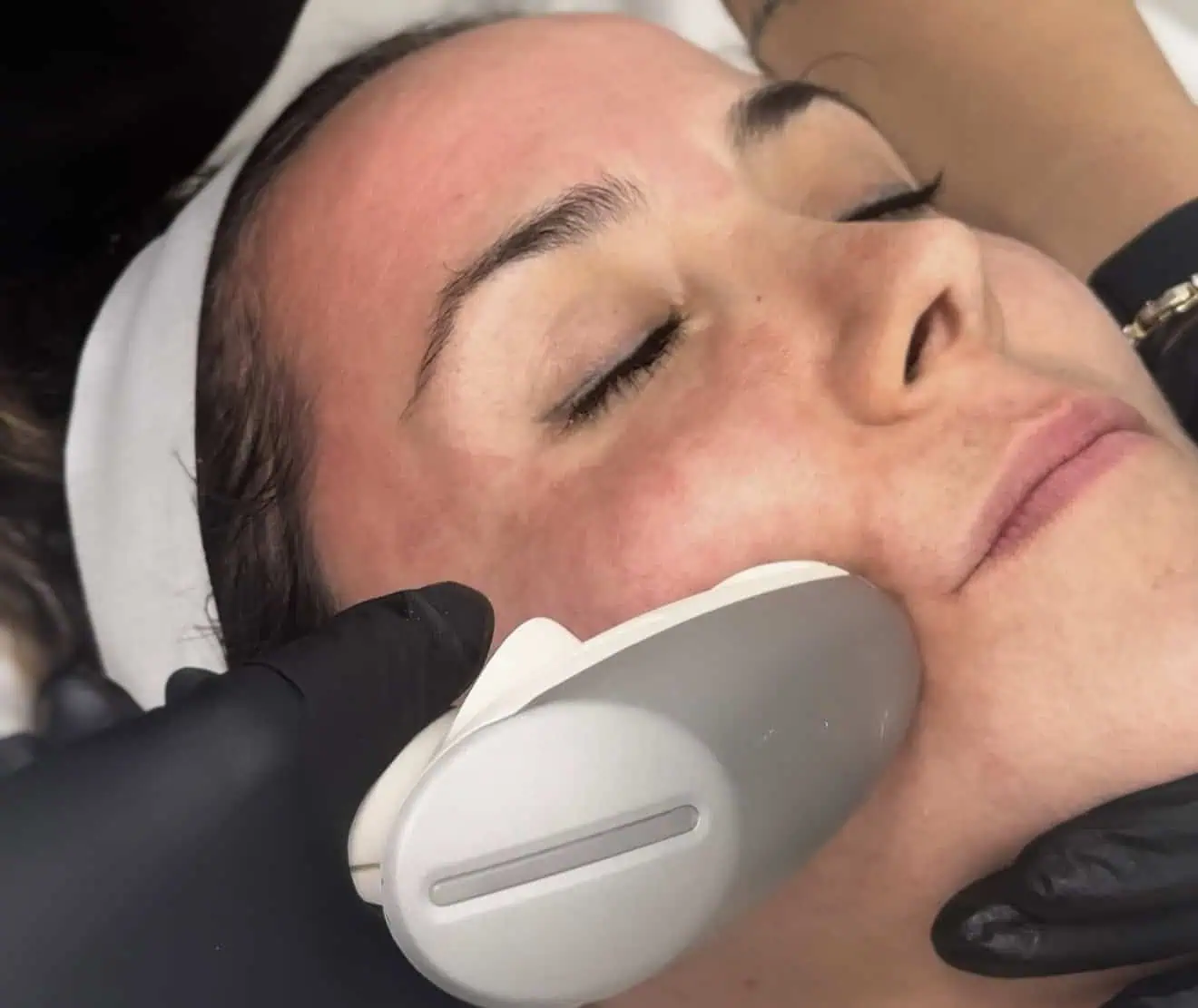 Advanced Sublative Skin Rejuvenation in North Miami, FL