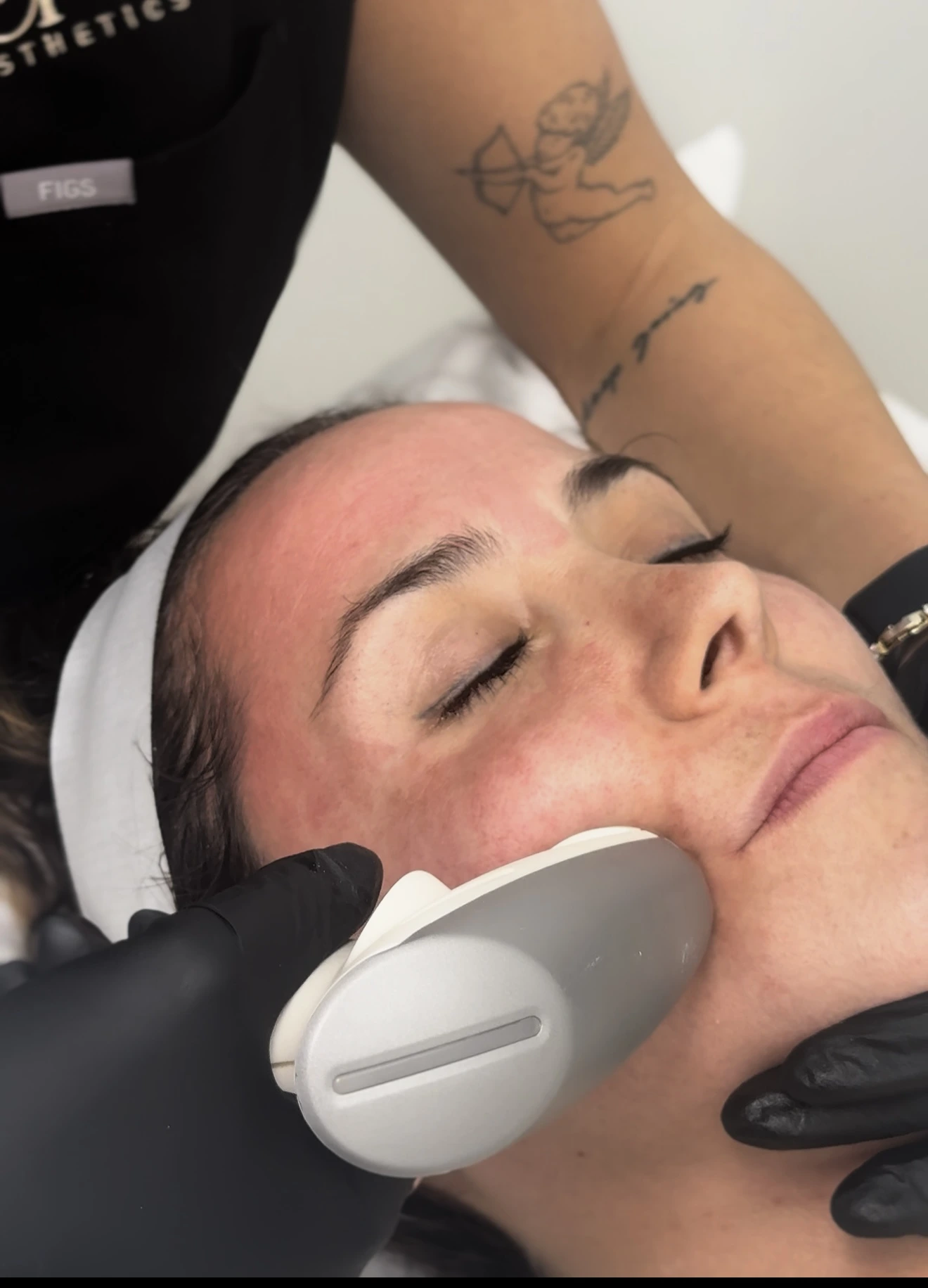 Sublative | Sublative™ Skin Rejuvenation