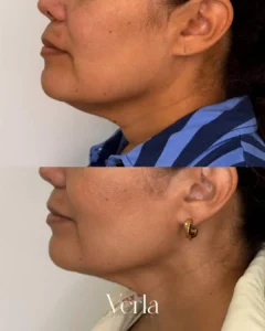C1364461 619D 4408 A58A 50C865BAB64C | Before and After
