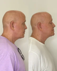 verlaaesthetics1 | Before and After