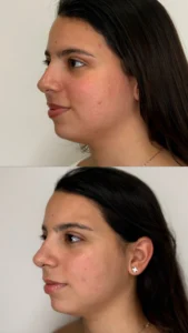 verlaaesthetics2 | Before and After