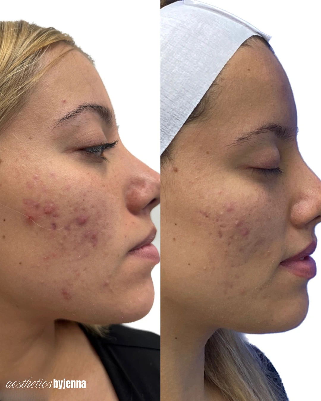 Acne Bootcamp 14 days apart | Before and After