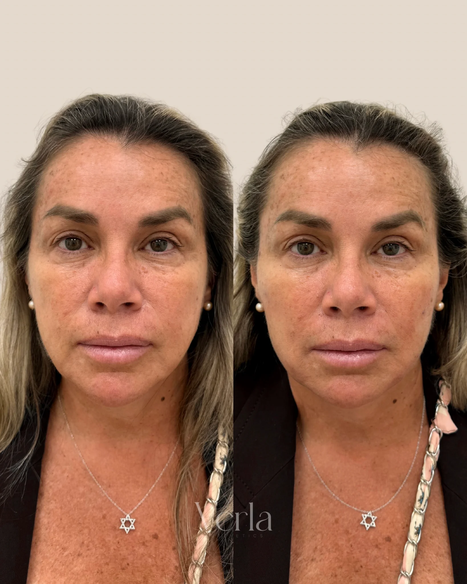 Biostimulator Treatment with Sculptra | Before and After