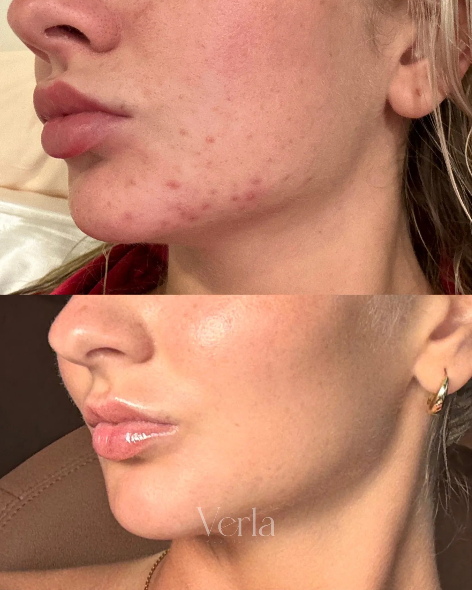 Chemical Peel Frax Laser Combo Treatment | Before and After