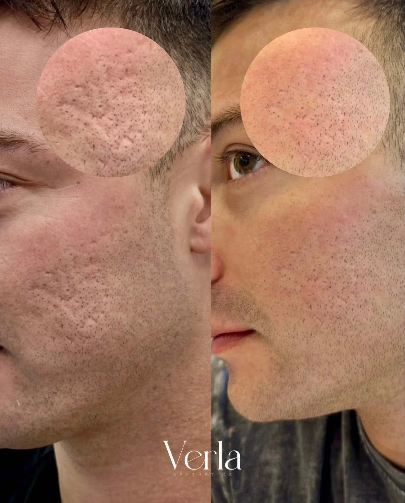 Combination Treatments Sublative Microneedling PRP Customized Skincare Regimen | Before and After