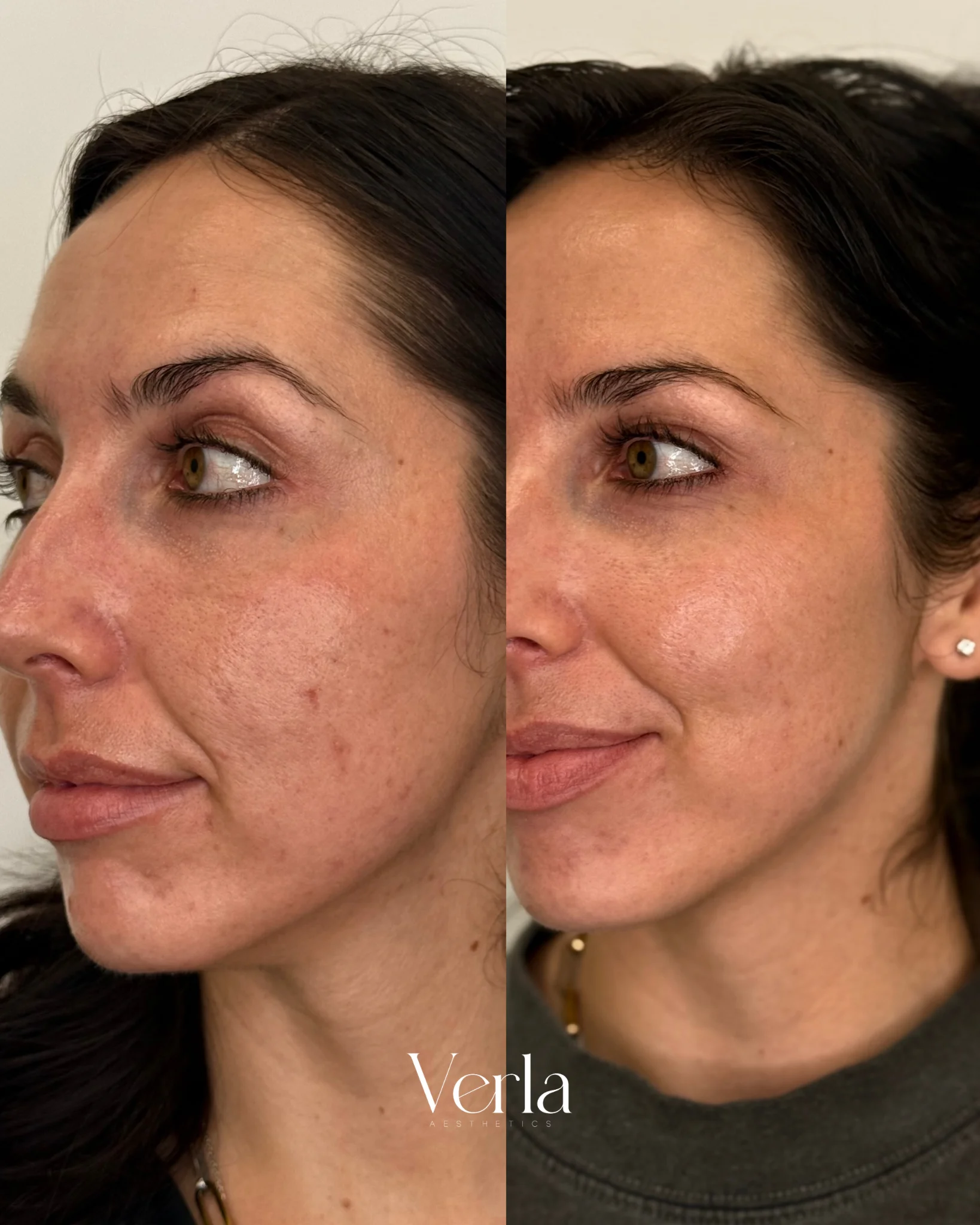 Customized Skincare Regimen 10 days apart | Before and After