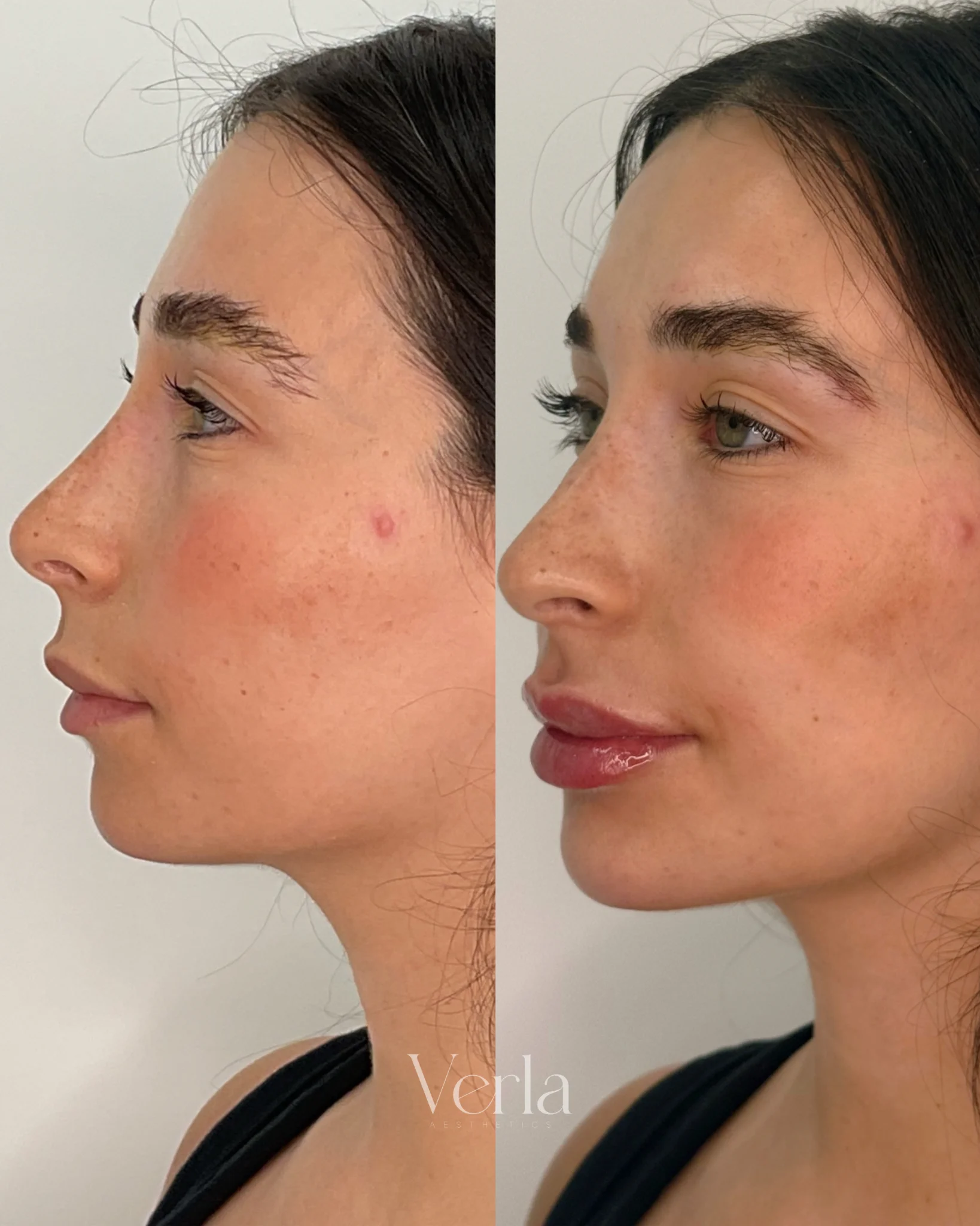 Facial Balancing with Dermal Fillers | Before and After