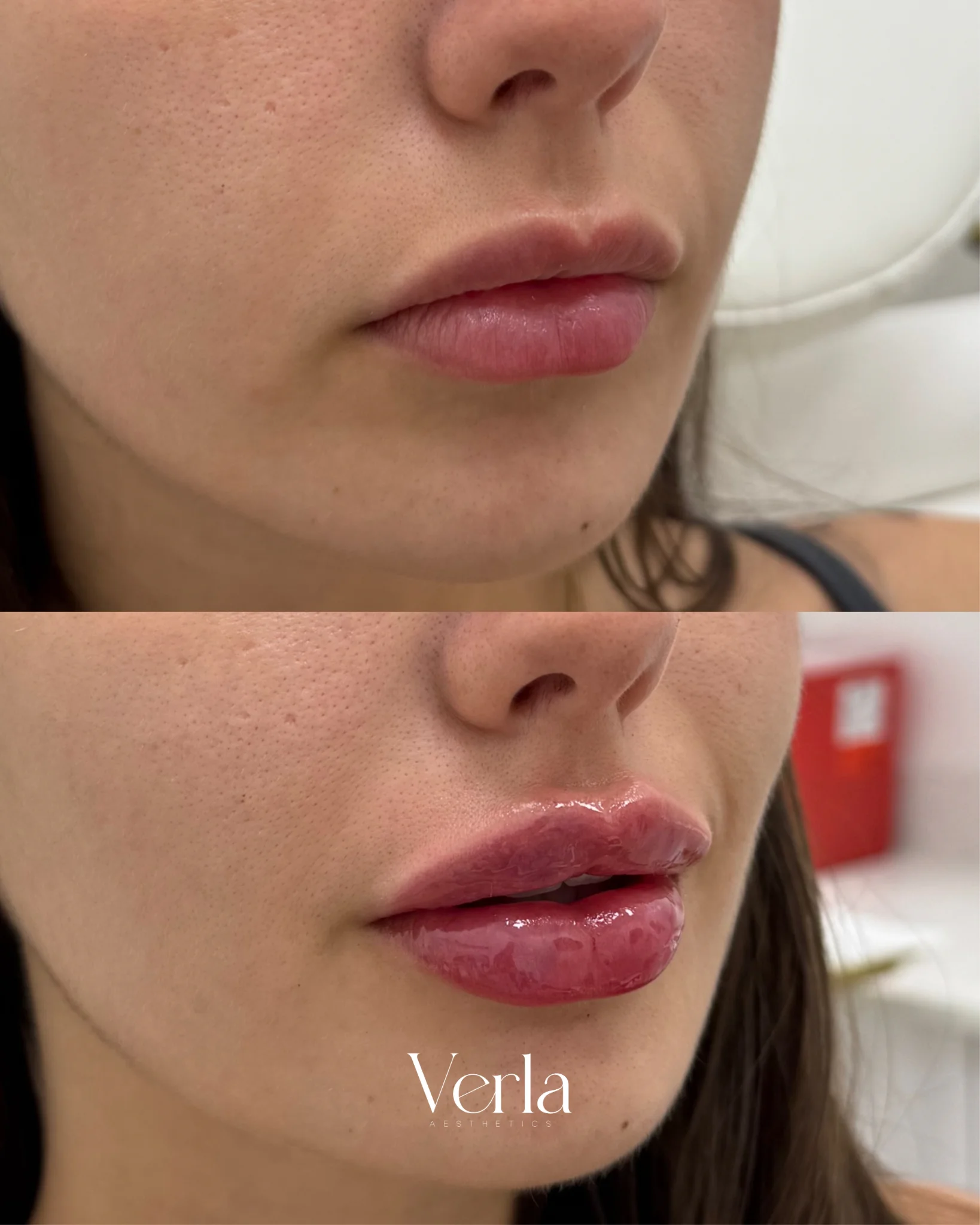 Lip Augmentation | Before and After