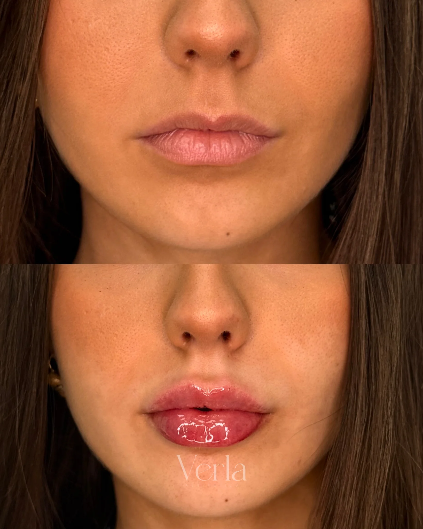 Lip Augmentation 1 | Before and After