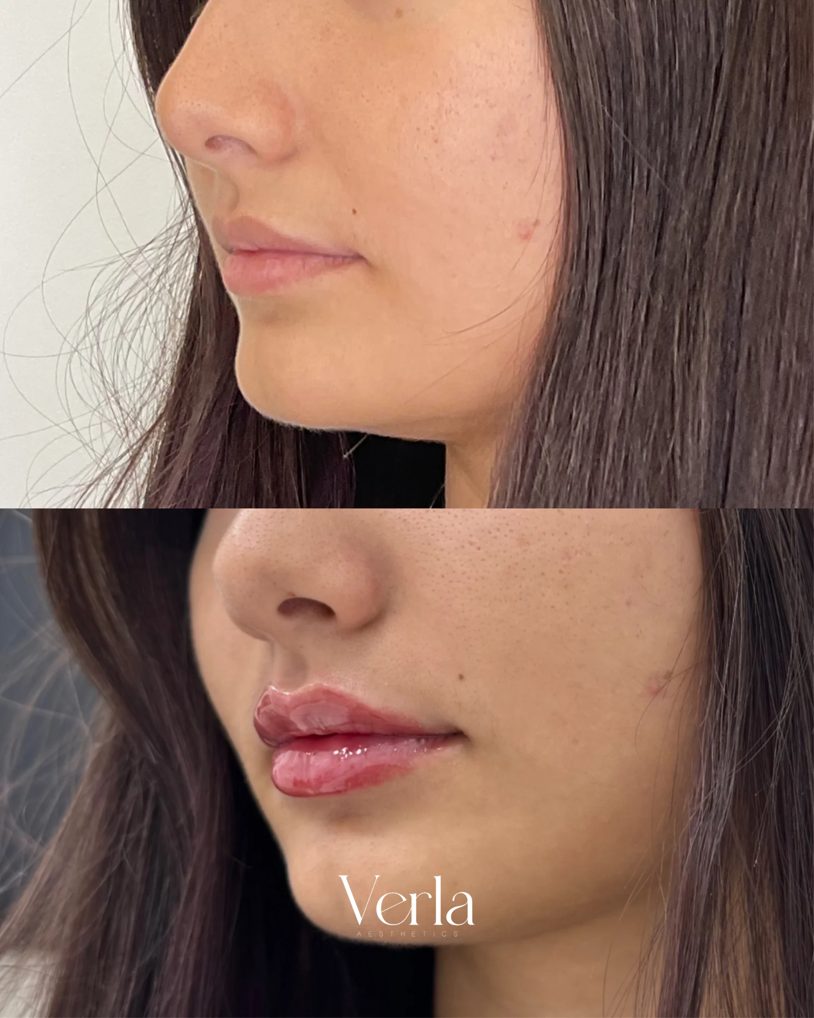 Lip Augmentation 2 | Before and After