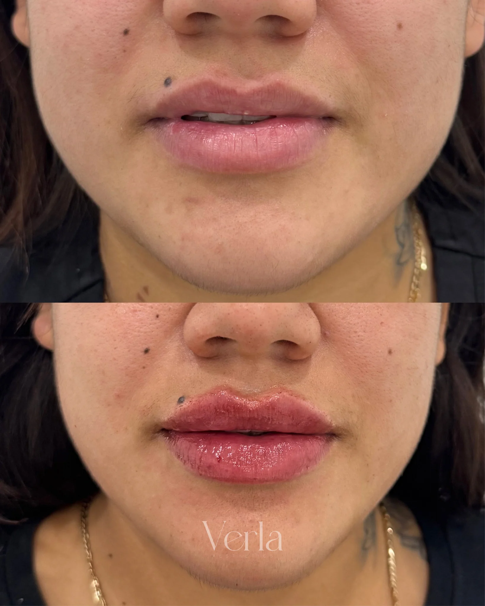 Lip Augmentation | Before and After