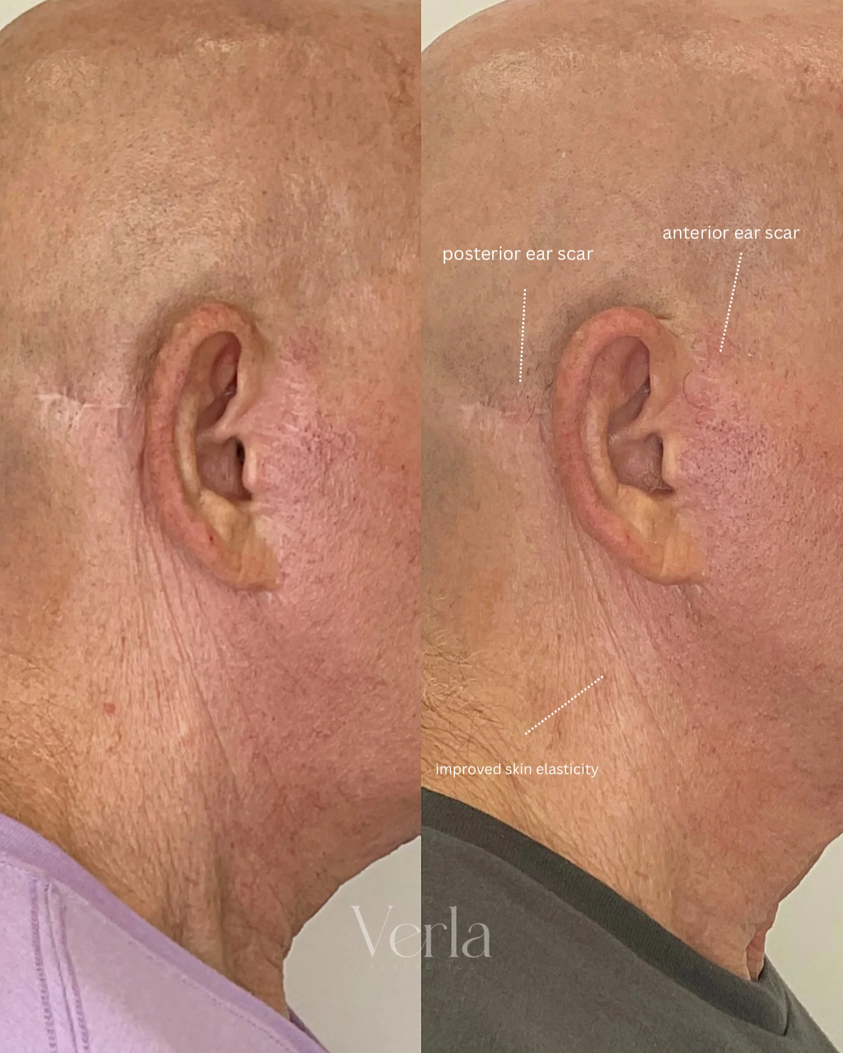 Morpehus 8 Scar Revision Skin Tightening | Before and After