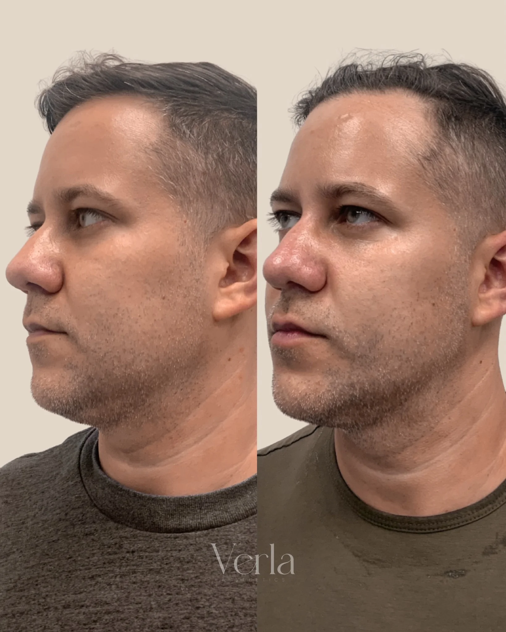 Morpheus 8 Customized Skincare Regimen | Before and After