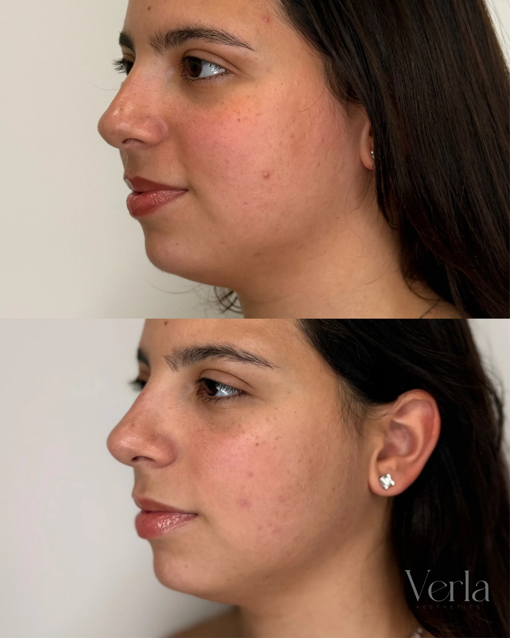 Morpheus 8 Facial Contouring | Before and After