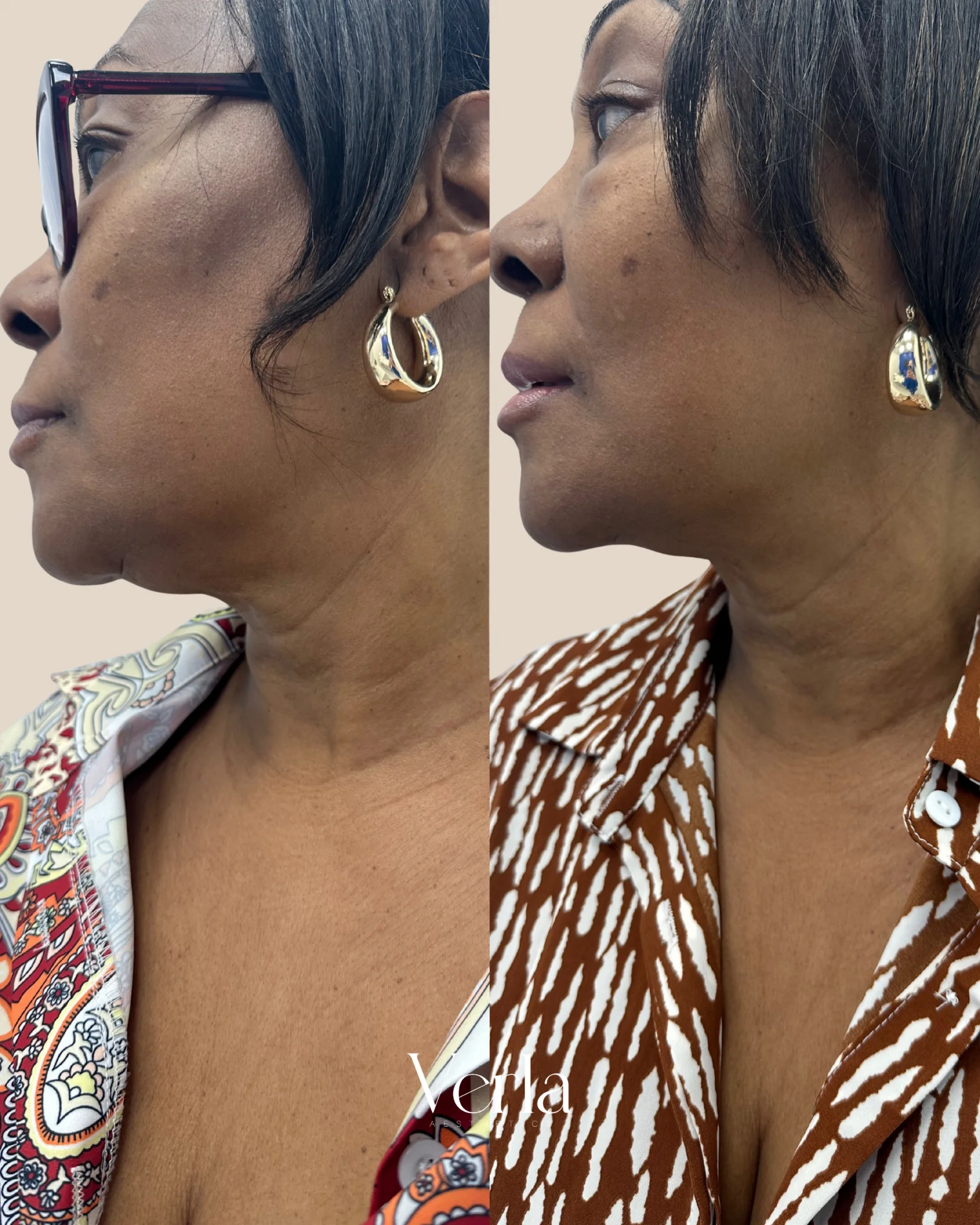Morpheus 8 Facial Contouring Techno Neck Perfecting Cream 1 | Before and After