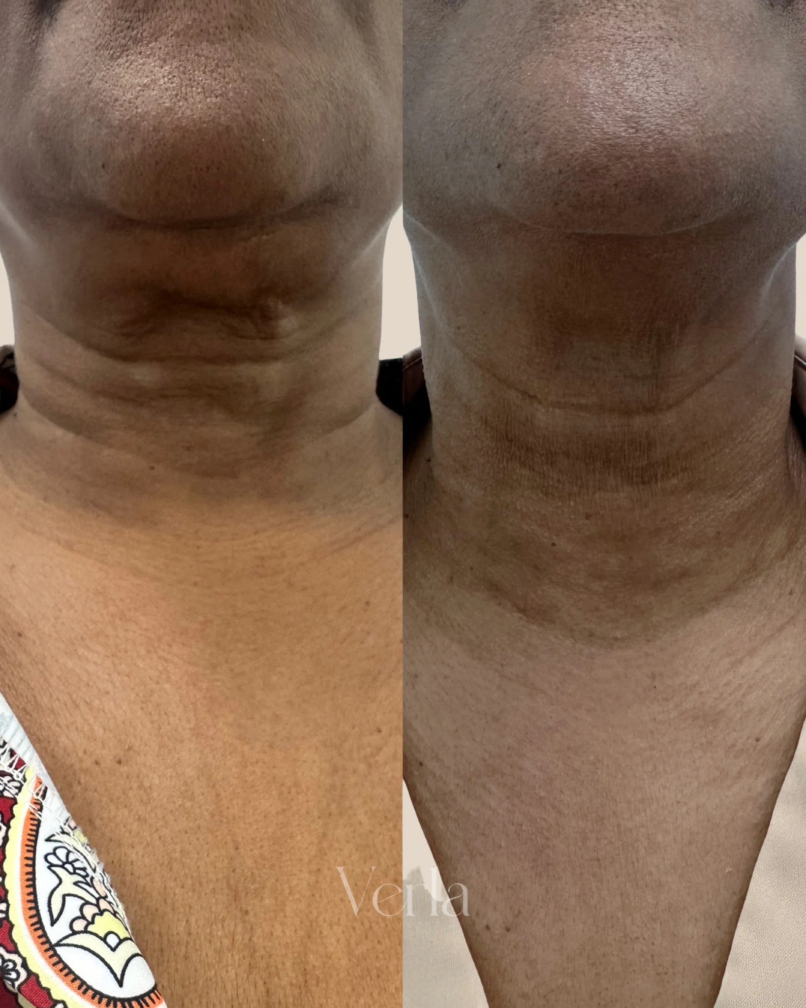 Morpheus 8 Facial Contouring Techno Neck Perfecting Cream | Before and After