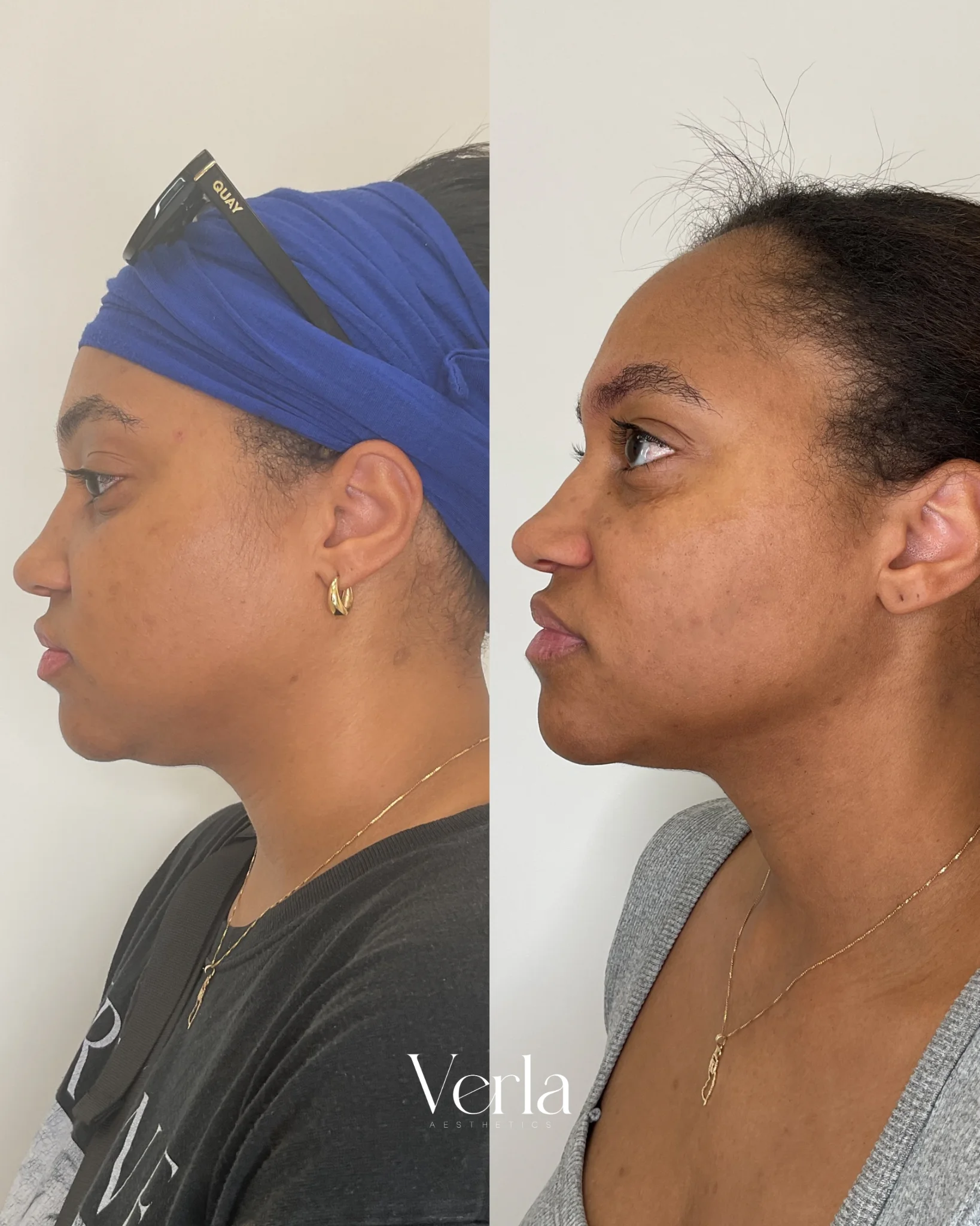 Morpheus 8 Full Face Neck Facial Contouring Submental Chin | Before and After