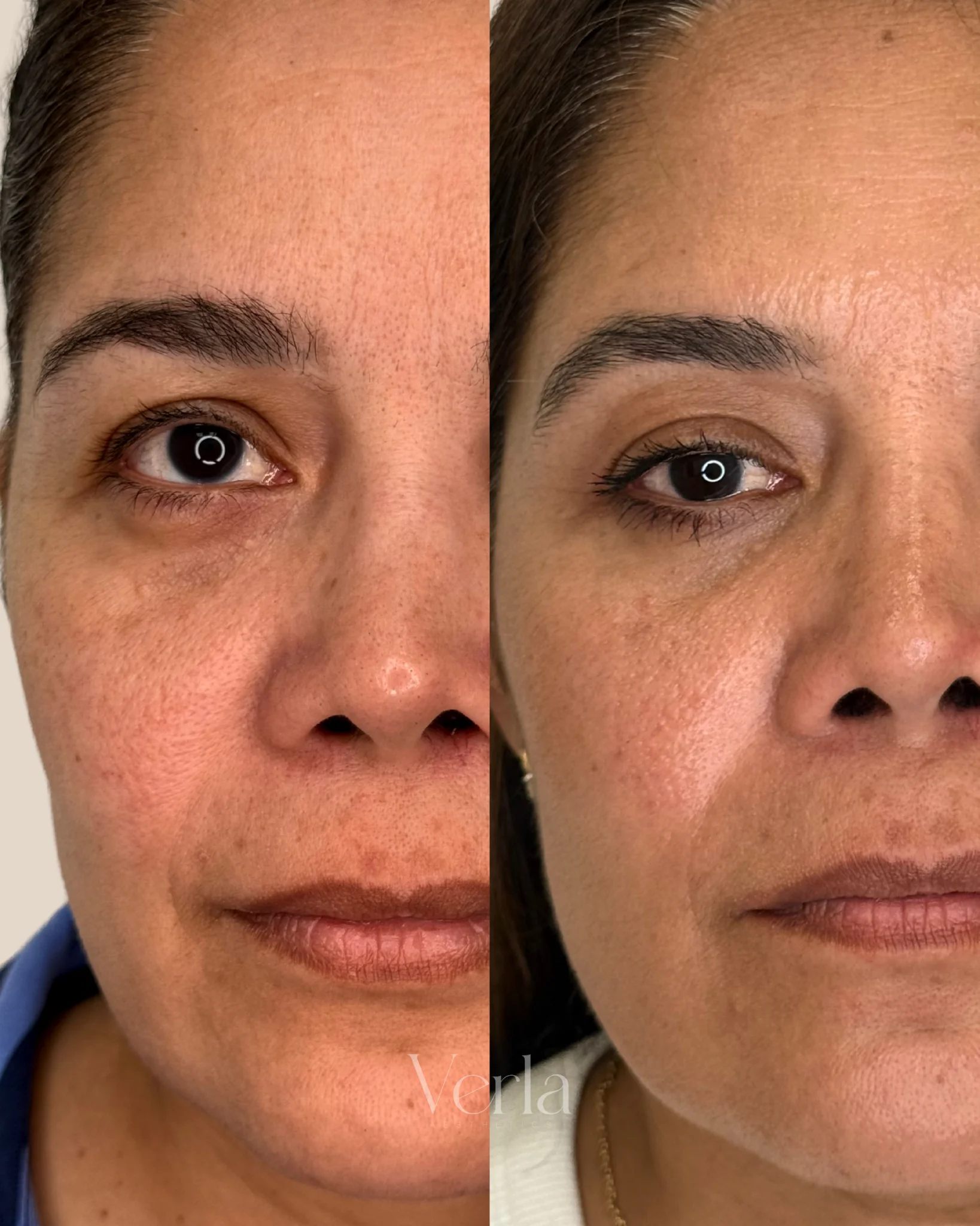 Morpheus 8 Skin Texture Pore Size | Before and After