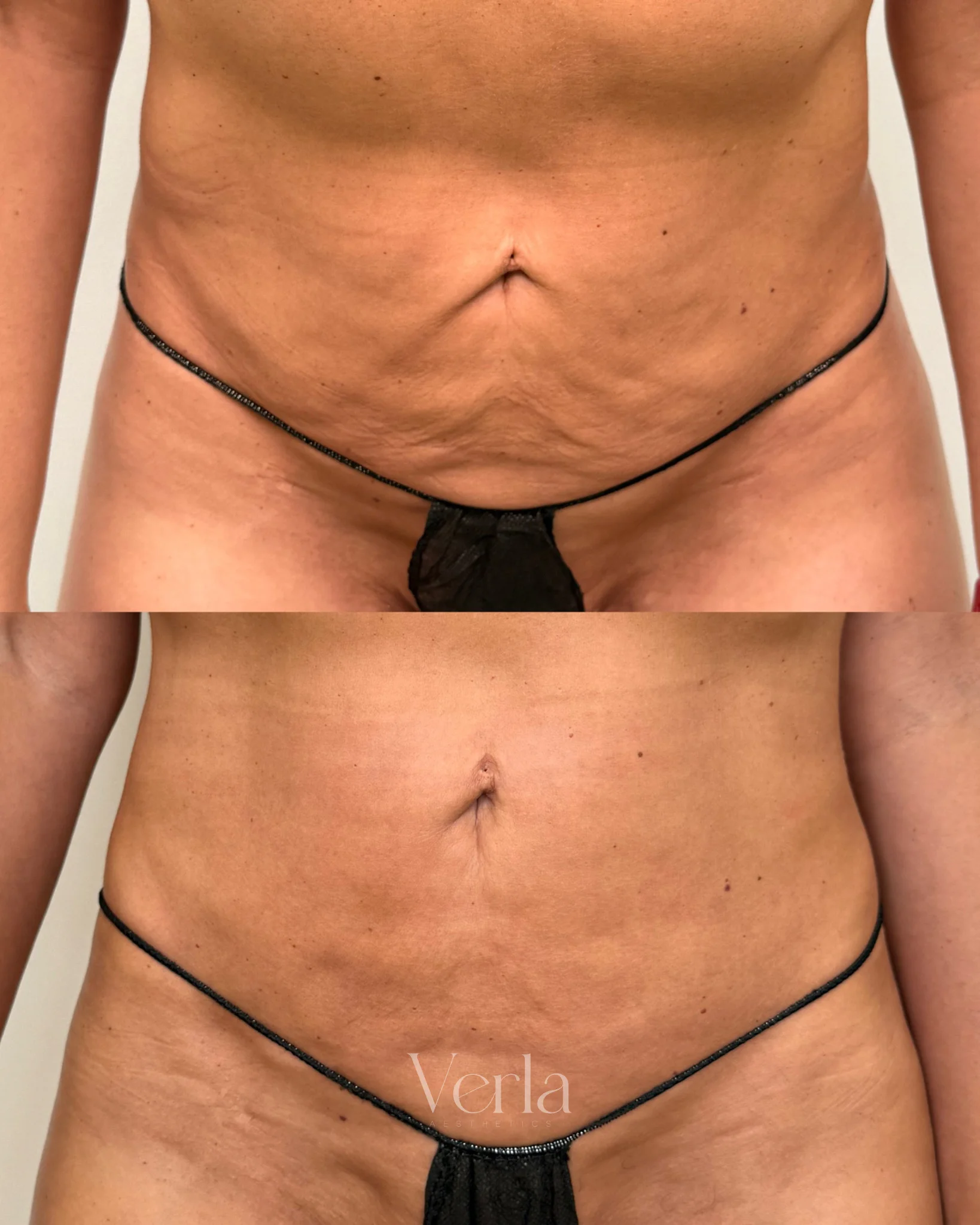 Morpheus 8 Skin Tightening | Before and After
