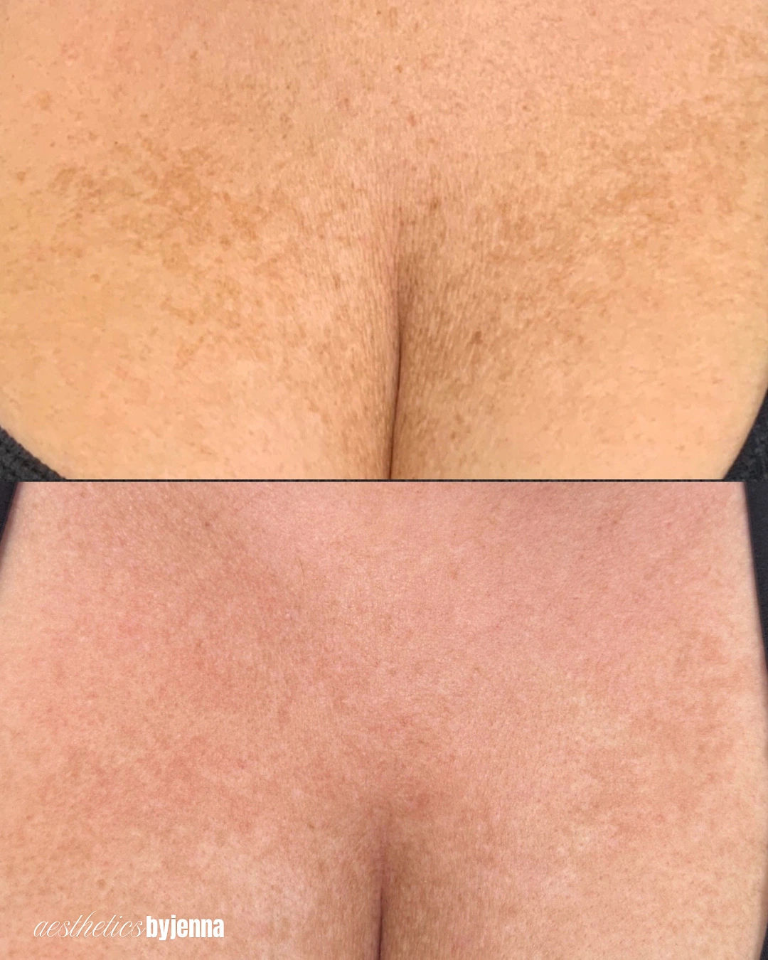 No More Pigment Laser Treatment | Before and After