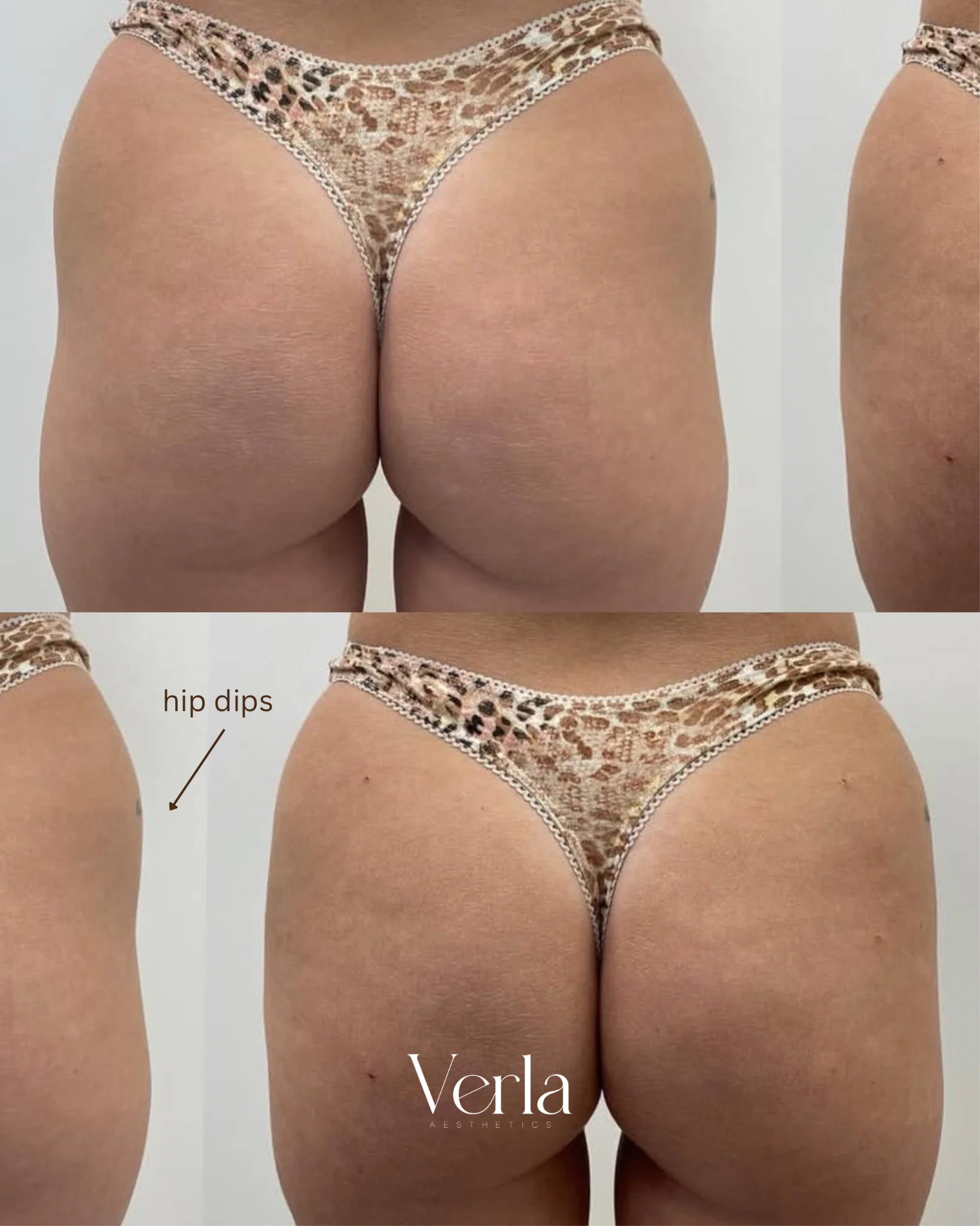 Non Surgical BBL Radiesse 10 Syringes Hip Dips | Before and After