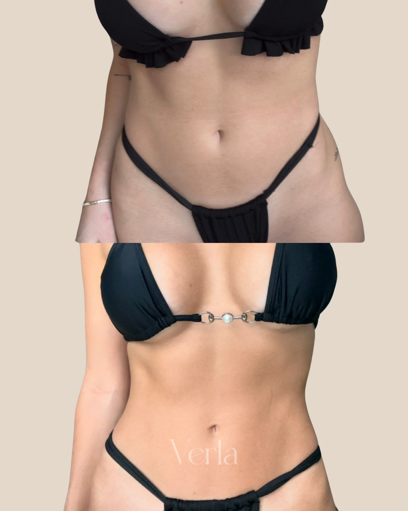 Sermorelin Peptide Therapy 3 Month Program | Before and After