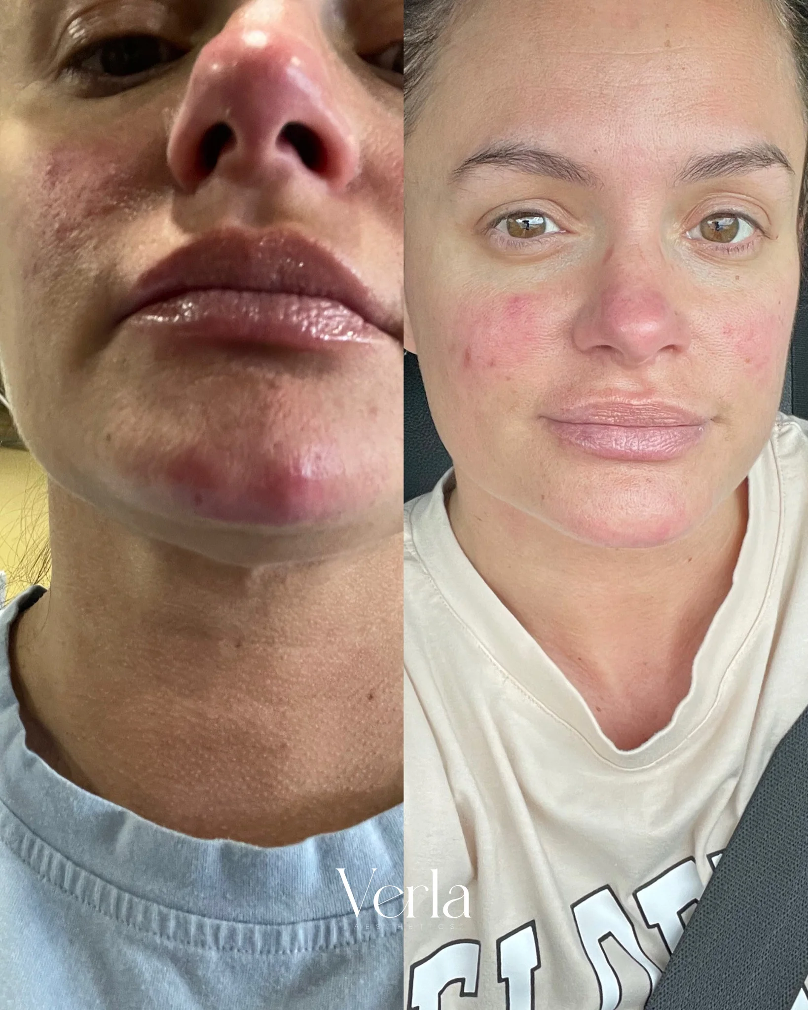 Virtual Skin Bootcamp Patient | Before and After