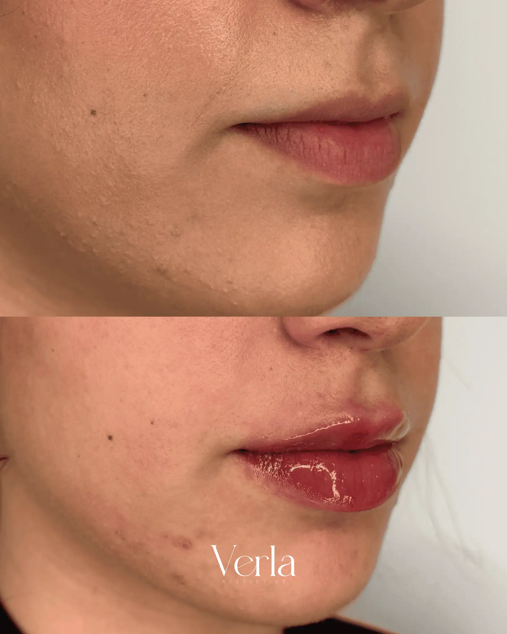 Lip Augmentation eight | Before and After