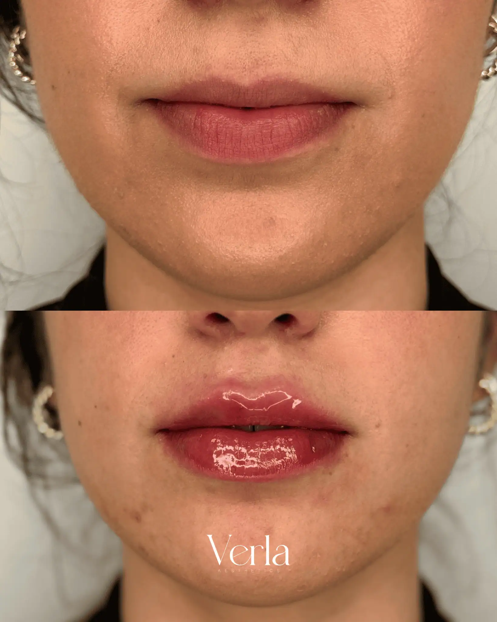 Lip Augmentation eleven | Before and After