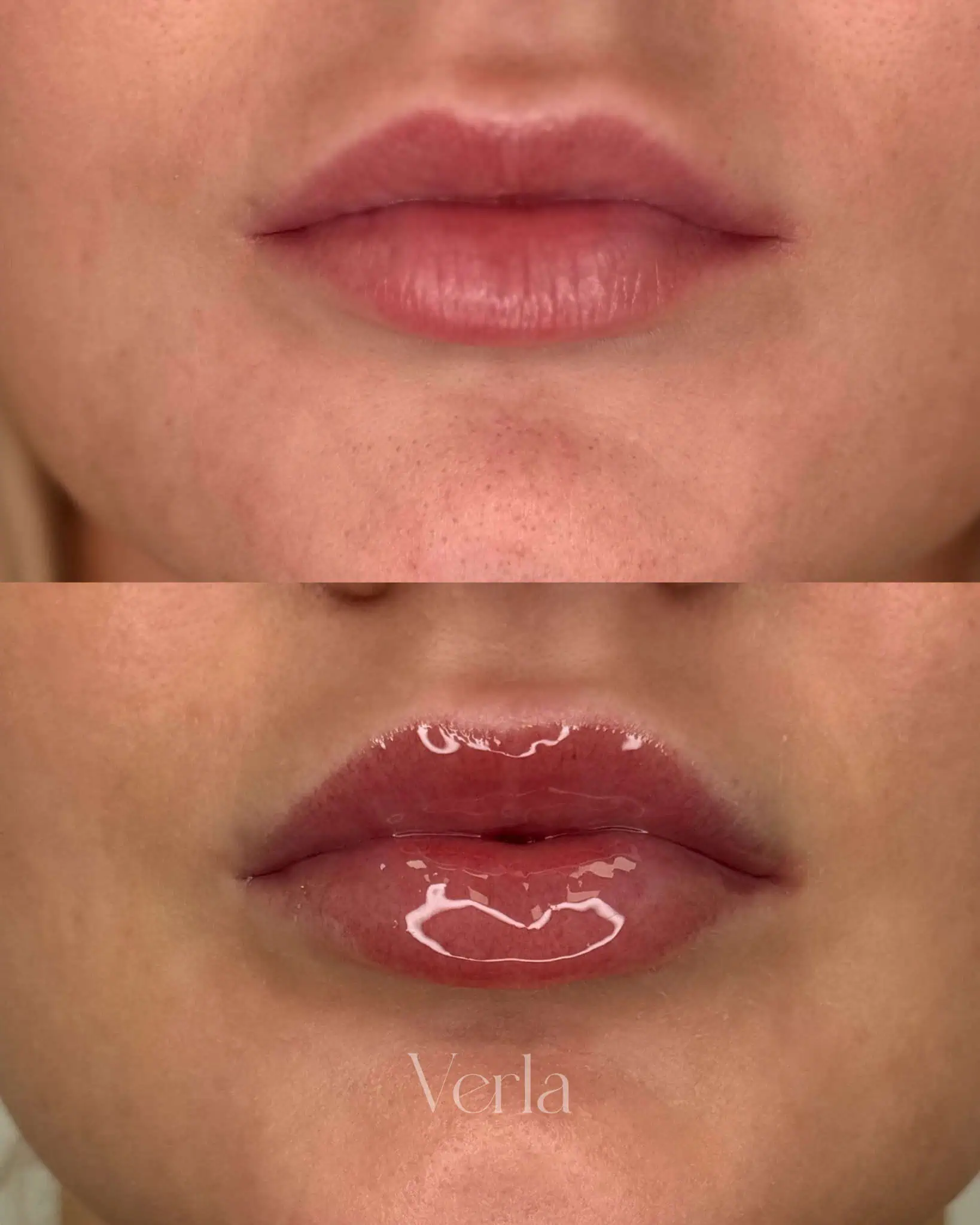 Lip Augmentation five | Before and After