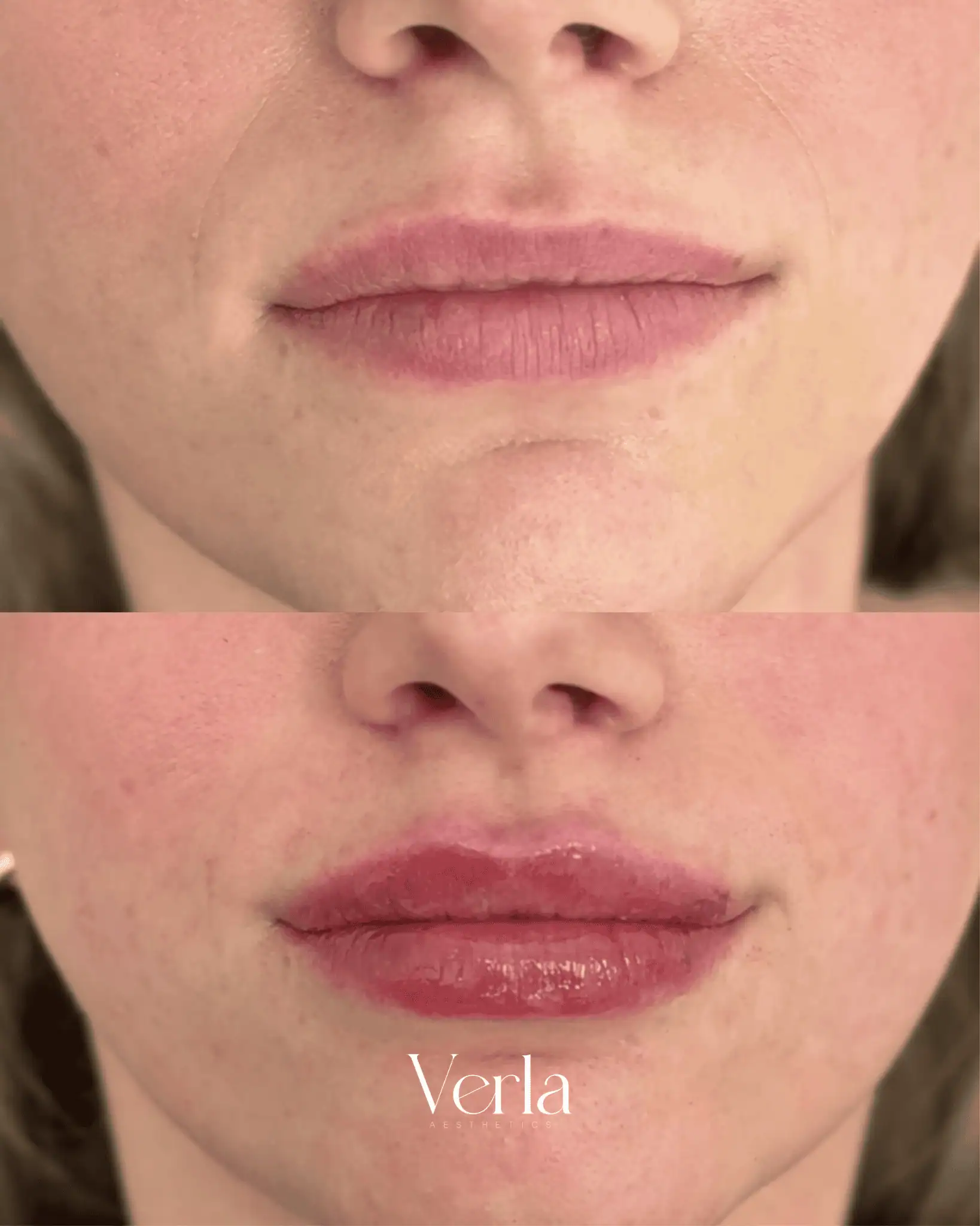 Lip Augmentation nine | Before and After