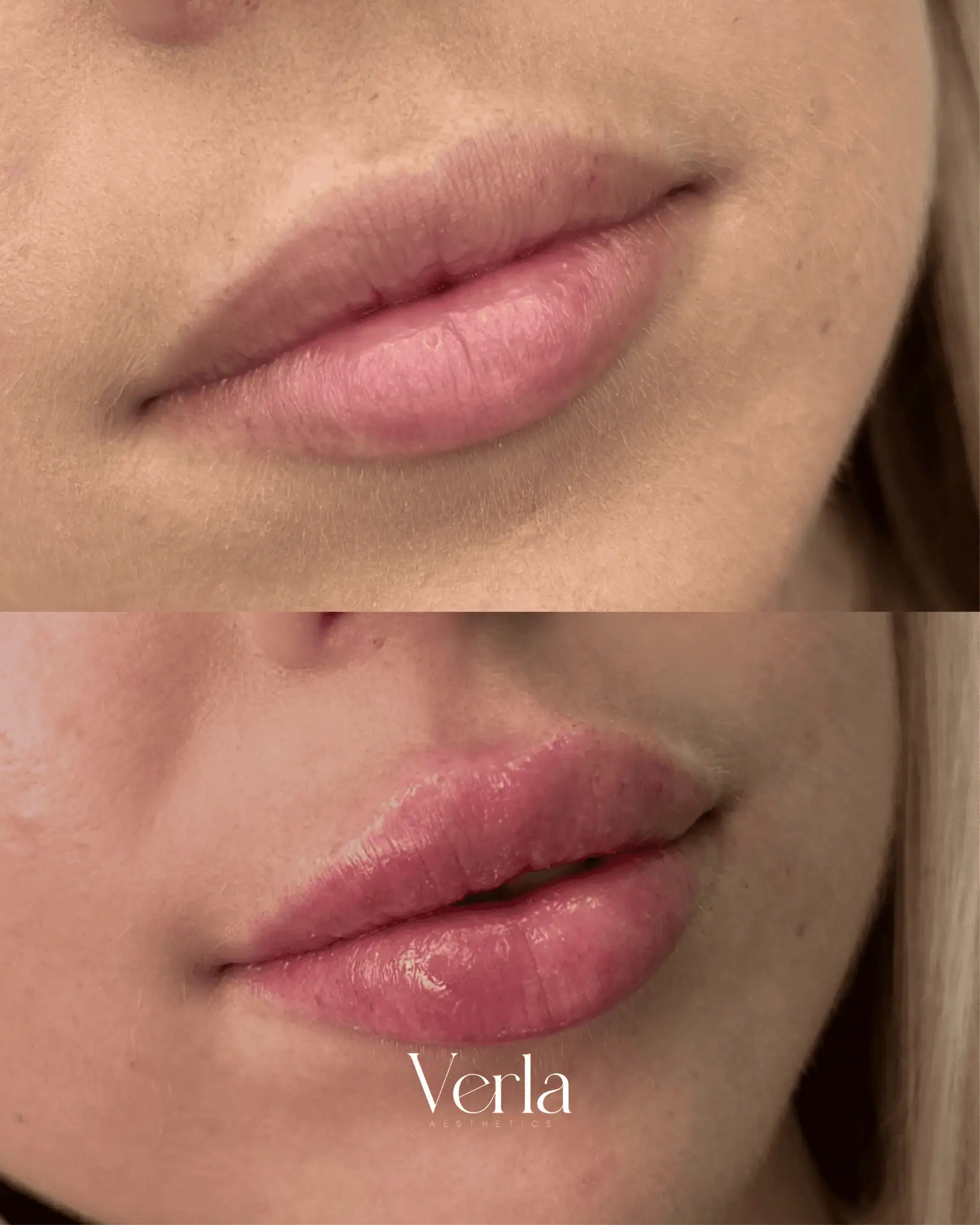 Lip Augmentation | Before and After