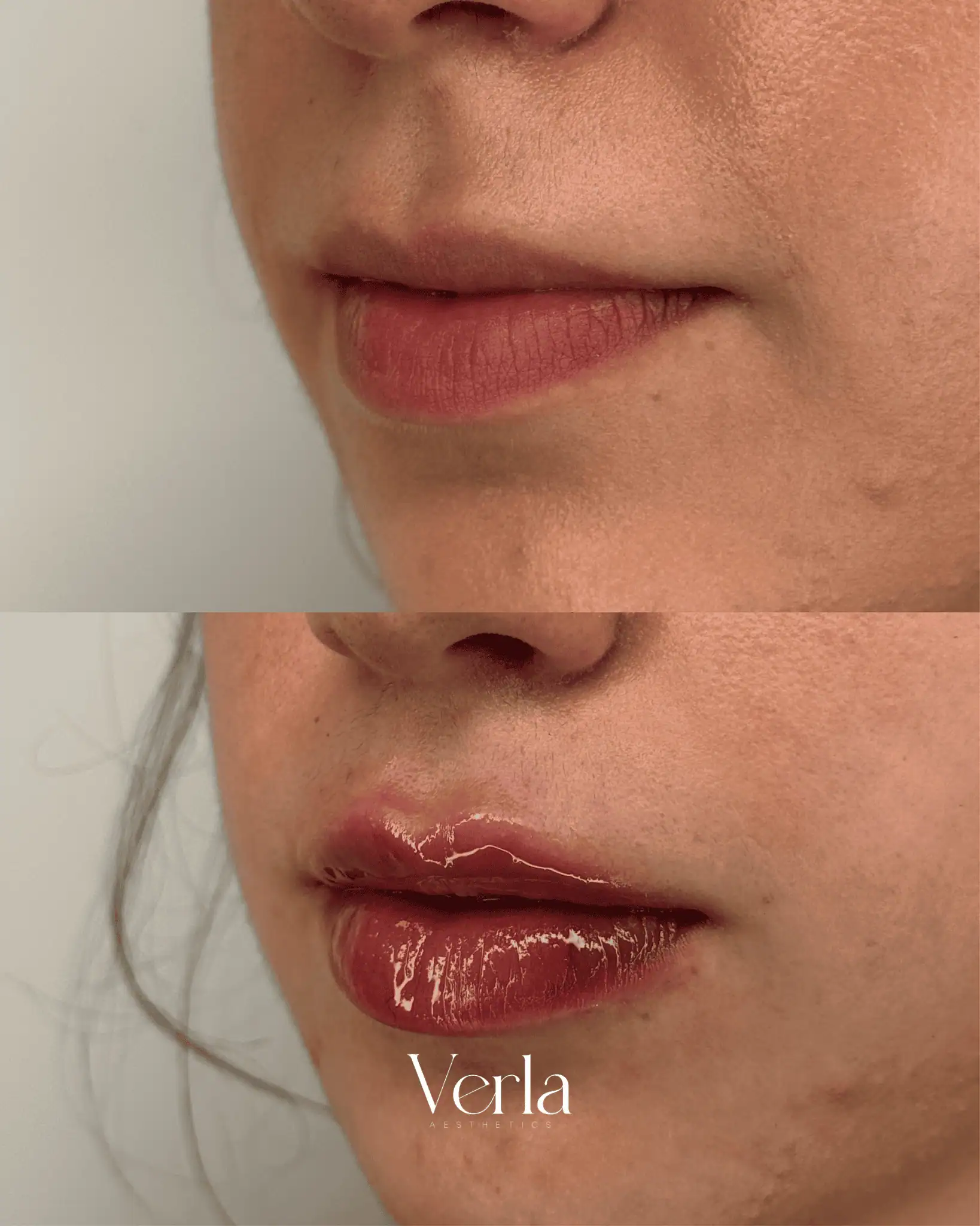 Lip Augmentation ten | Before and After