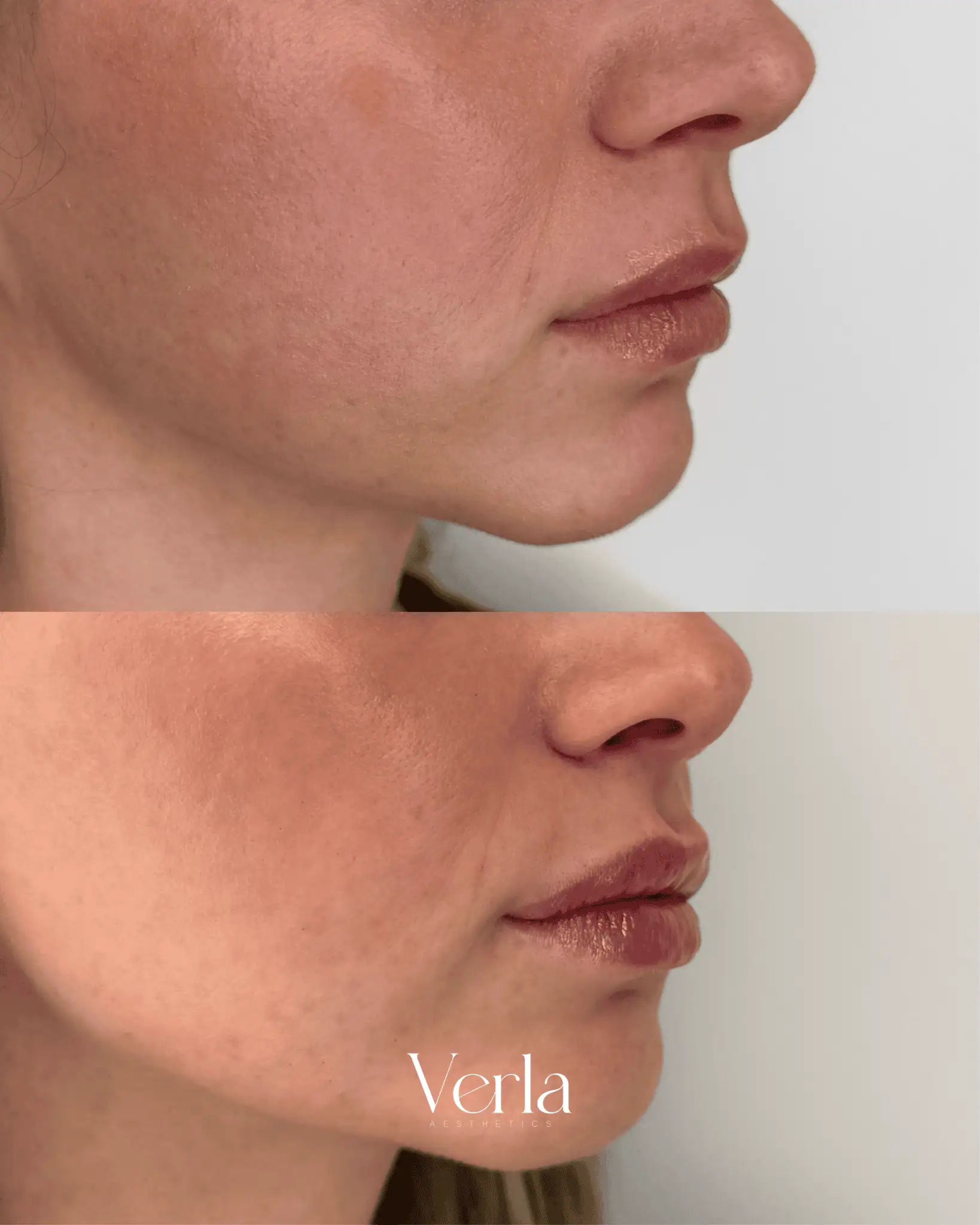 Lip Augmentation twelve | Before and After