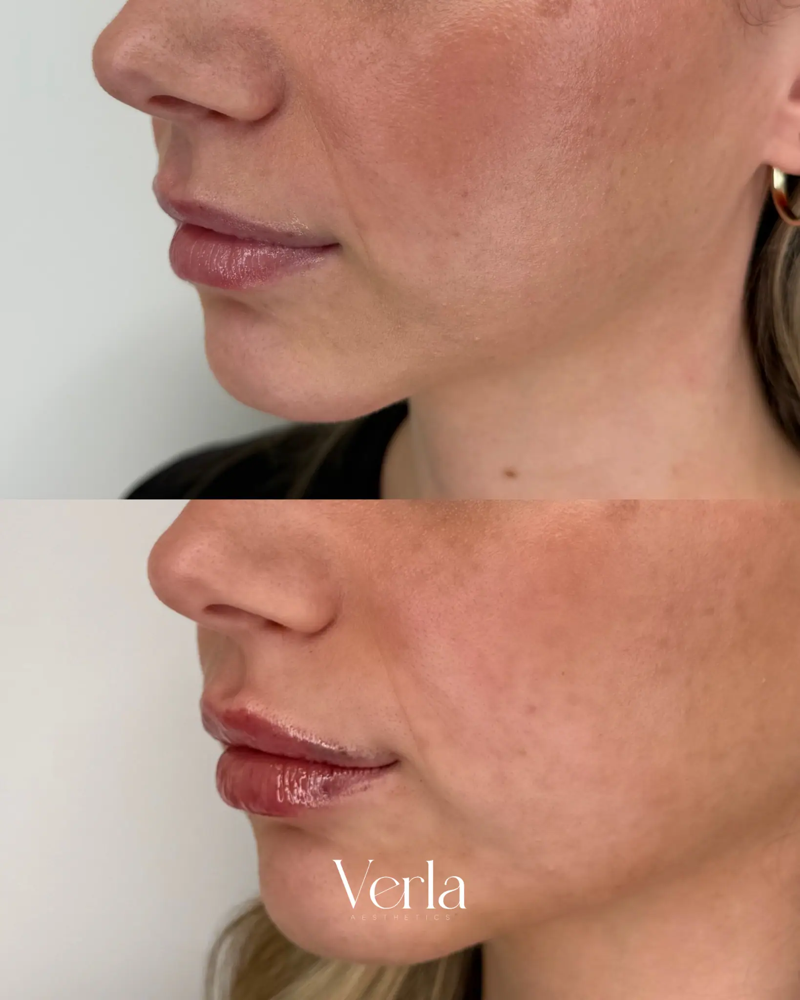 lip Aigmentation seven | Before and After