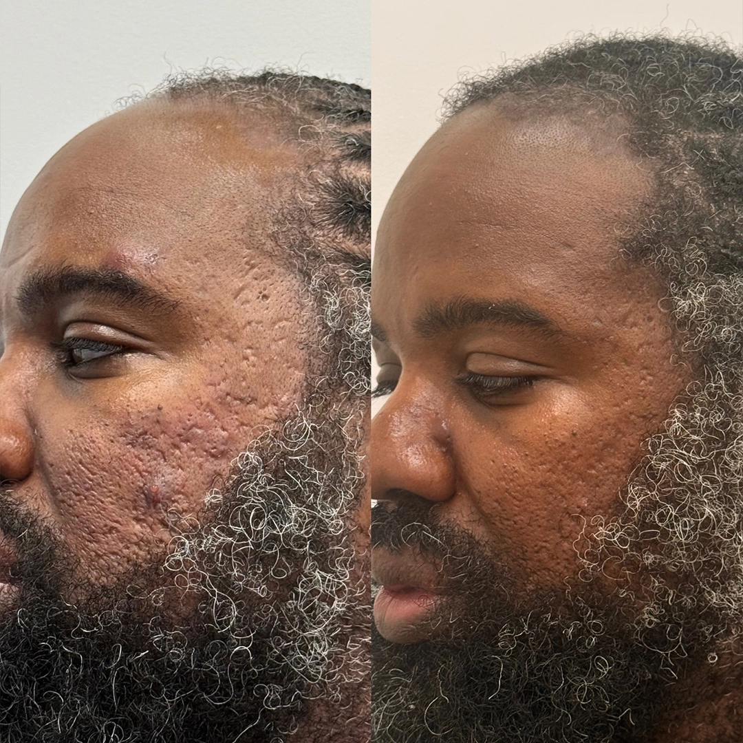 Chemical Peels 6 Chemical Peel Before & After 1