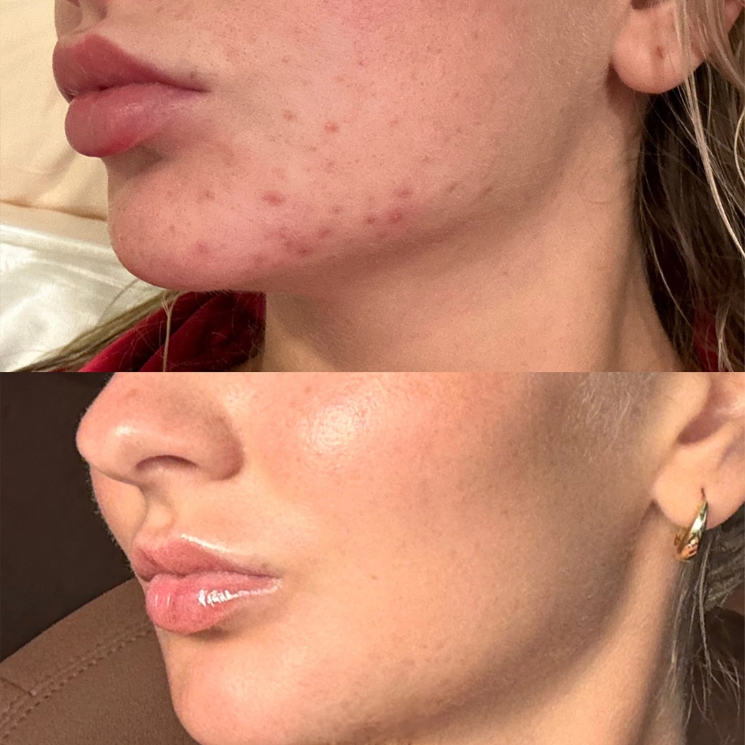 Chemical Peels 7 Chemical Peel Before & After 2