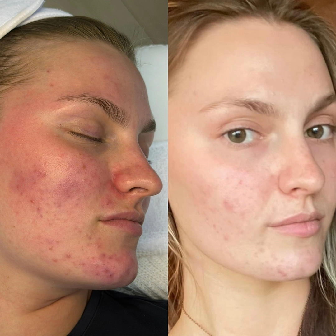 Chemical Peels 3 Chemical Peel Before & After 3