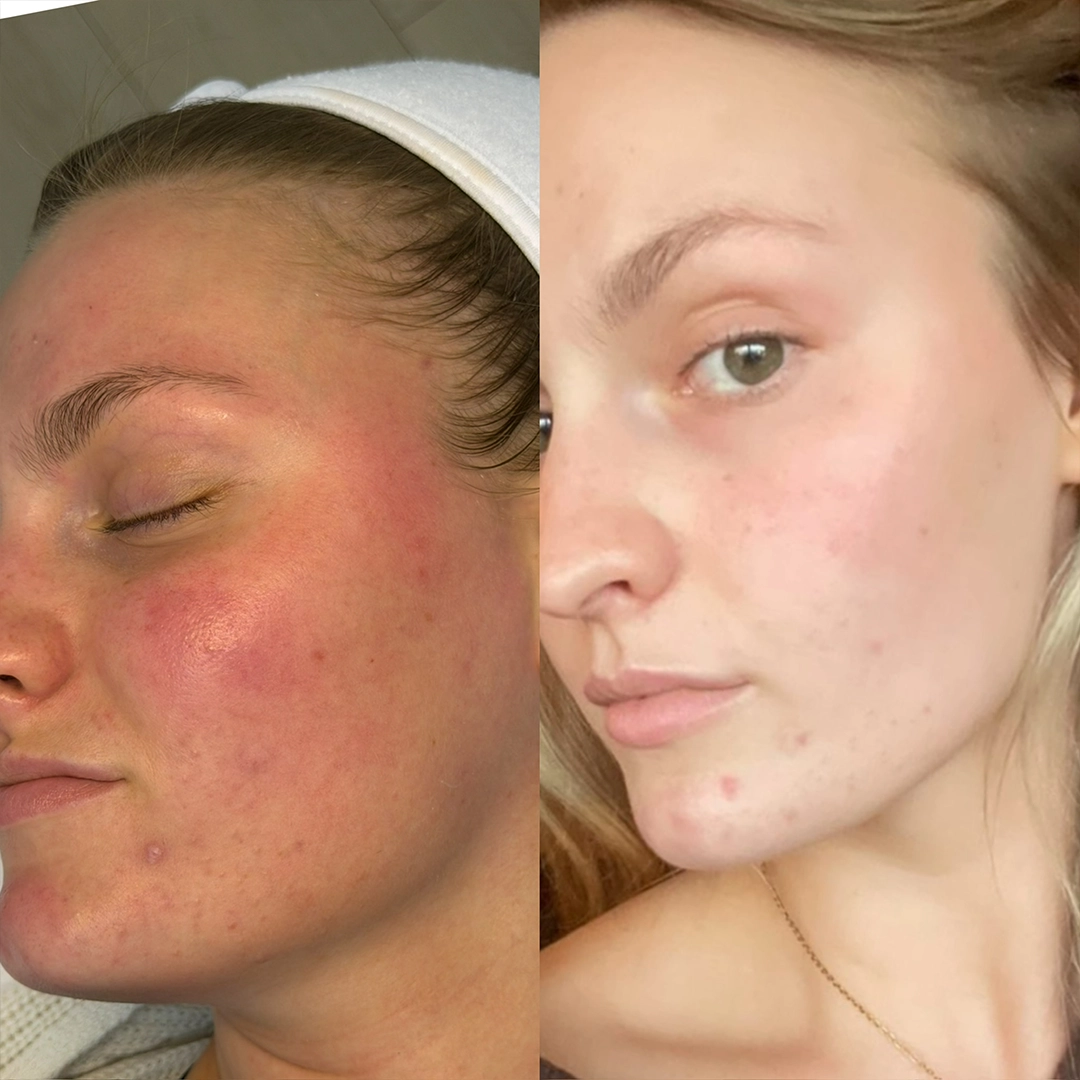 Chemical Peels 4 Chemical Peel Before & After 4