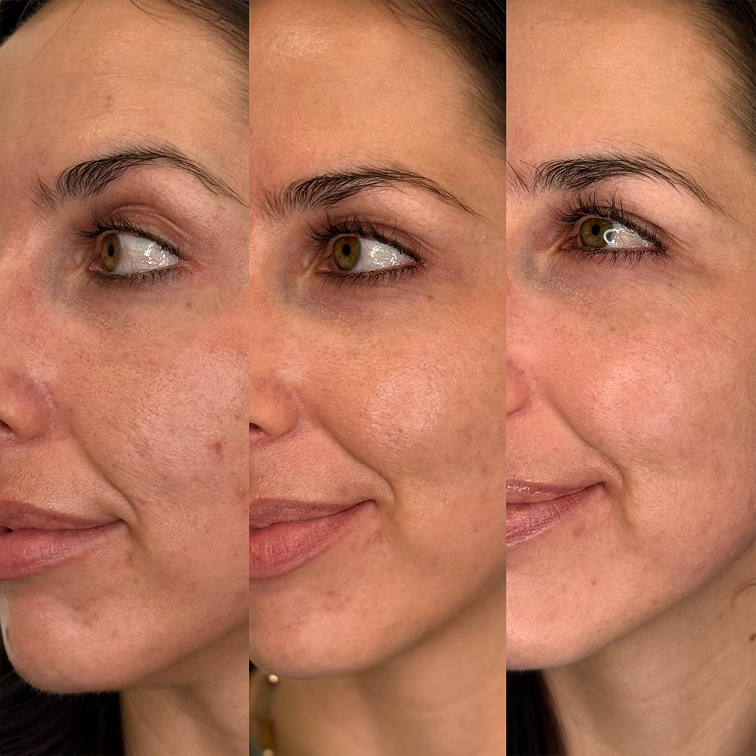 Chemical Peels 8 Chemical Peel Before & After 5