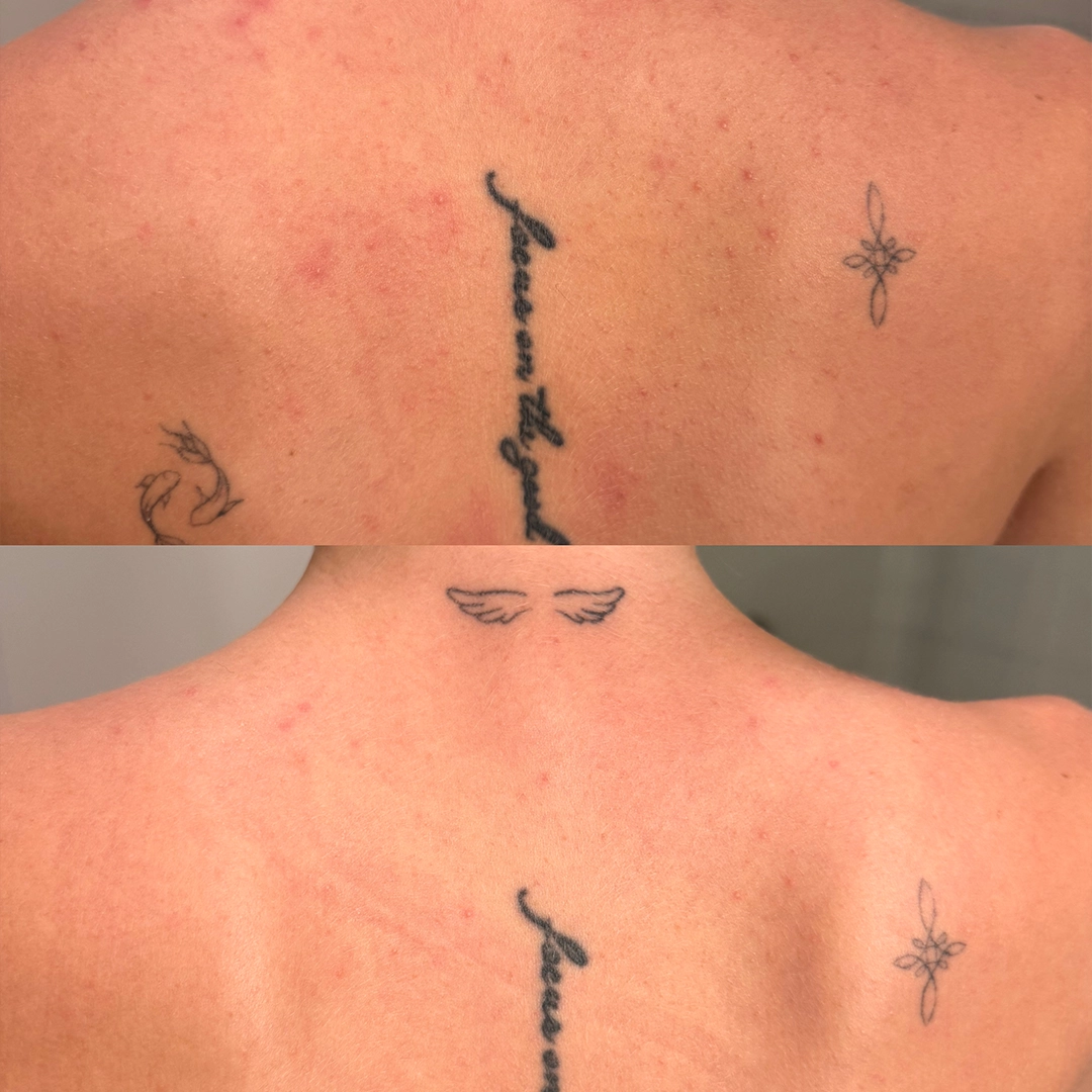 Chemical Peels 5 Chemical Peel Before & After 6