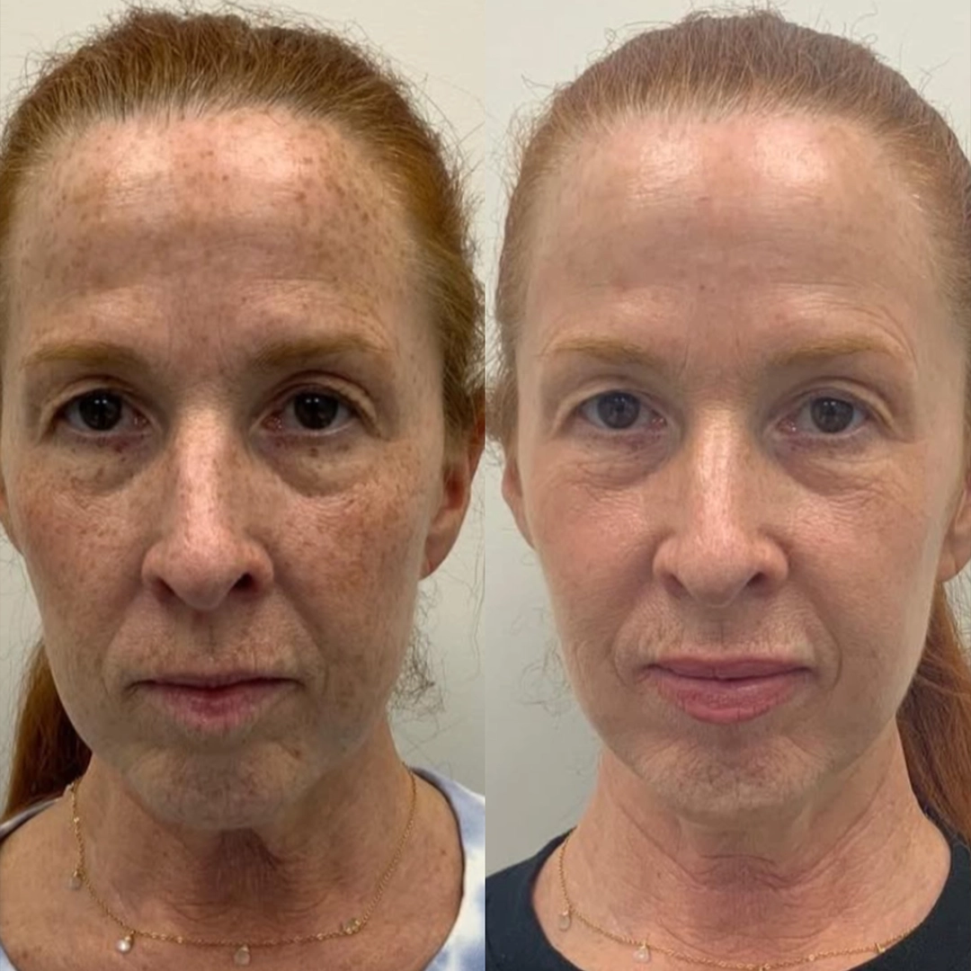 Candela™ Frax Pro 1940 Laser 2 Frax laser Before & After 1