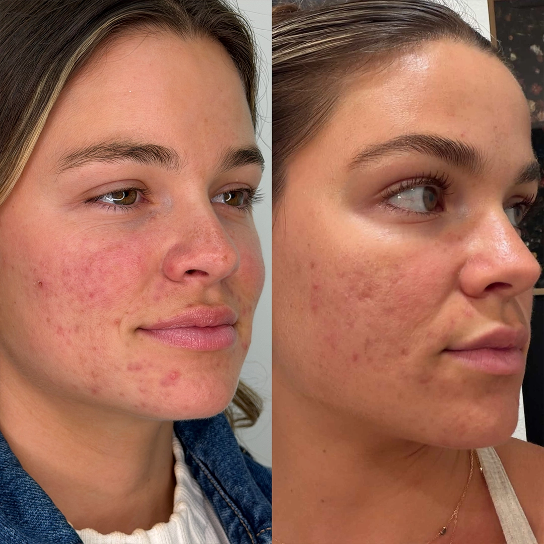 Candela™ Frax Pro 1940 Laser 3 Frax laser Before & After 2
