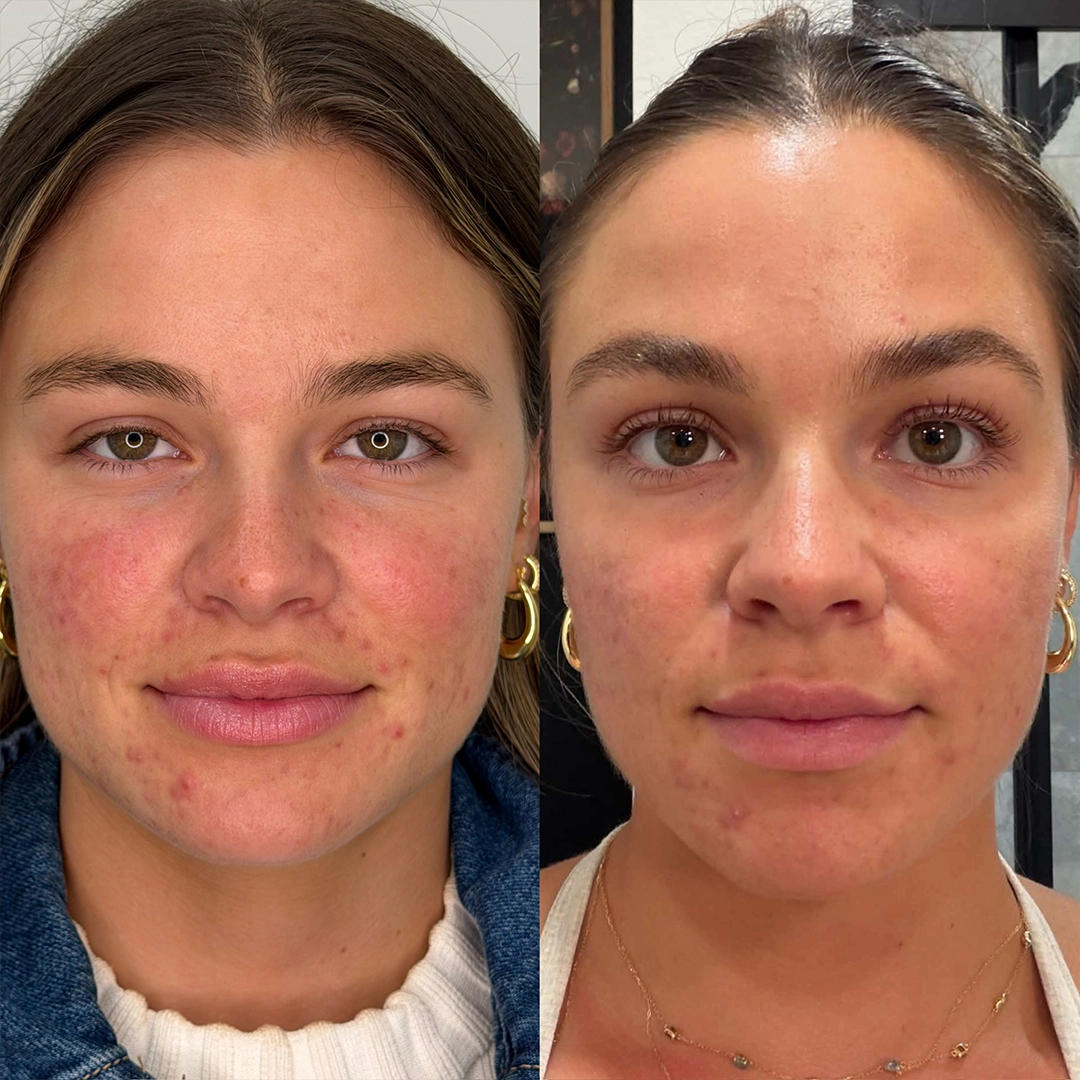 Candela™ Frax Pro 1940 Laser 4 Frax laser Before & After 3