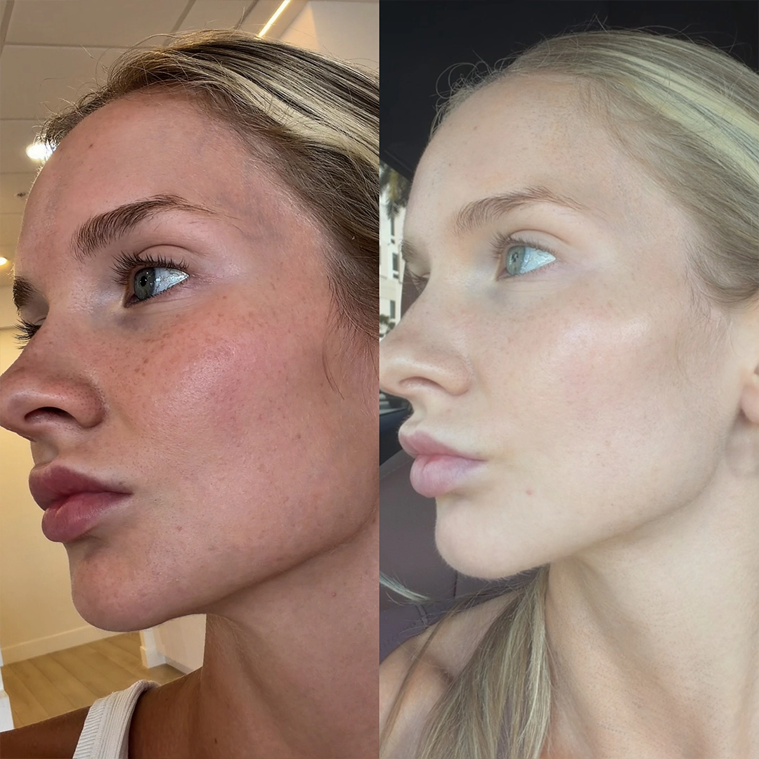 Candela™ Frax Pro 1940 Laser 5 Frax laser Before & After 4