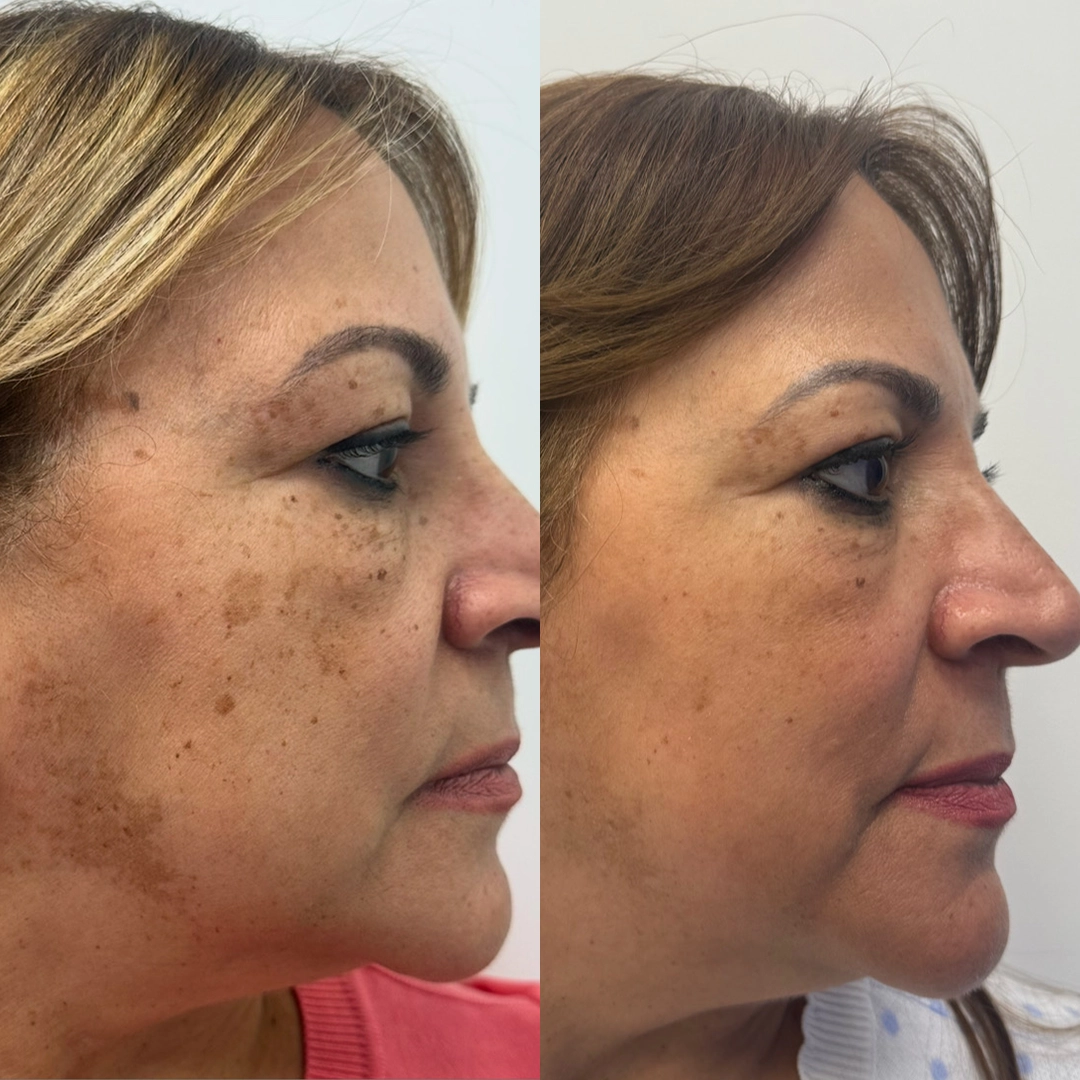 Candela™ Frax Pro 1940 Laser 6 Frax laser Before & After 5