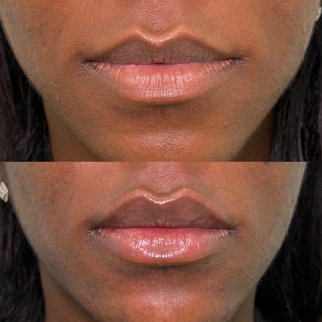 Dermal Filler 21 Lip Filler Before & After 1