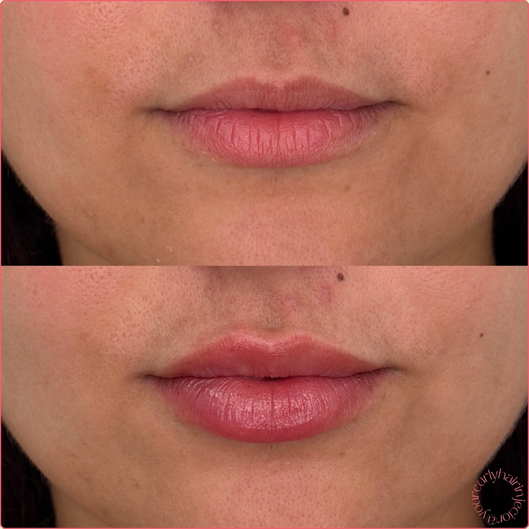 Dermal Filler 30 Lip Filler Before & After 10