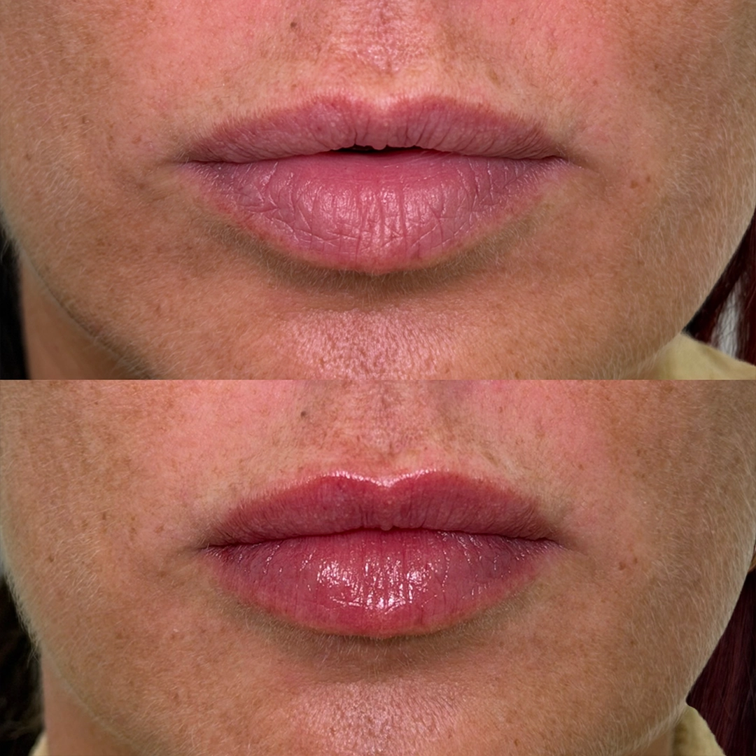 Dermal Filler 31 Lip Filler Before & After 11